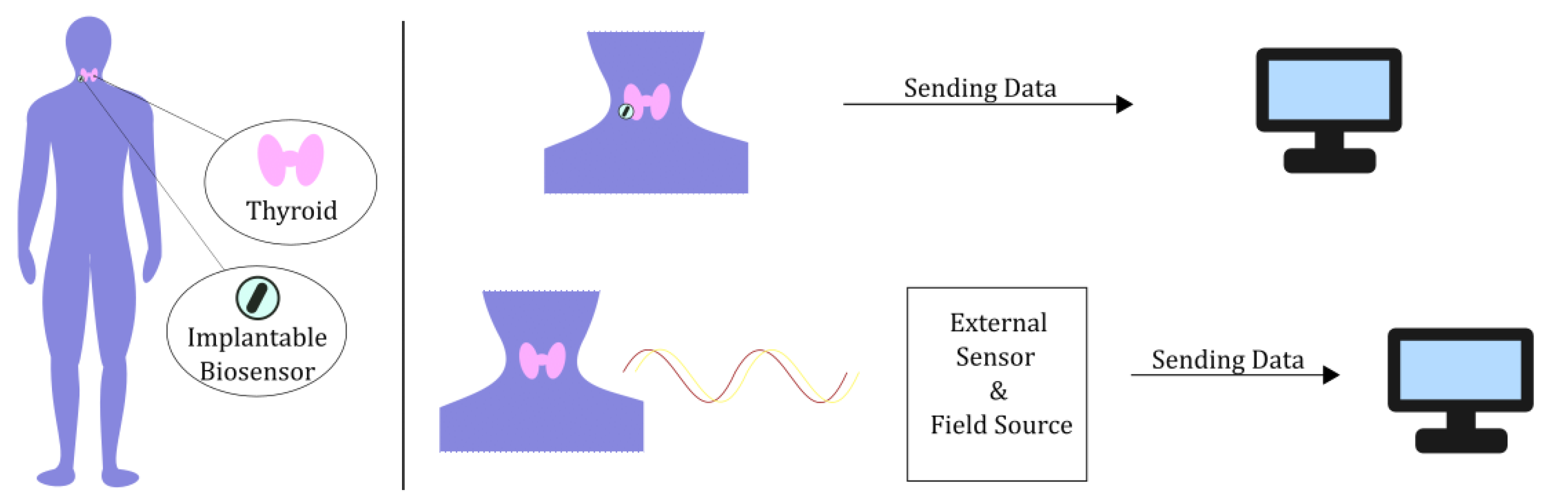 Thyroid Screening Techniques via Bioelectromagnetic Sensing 