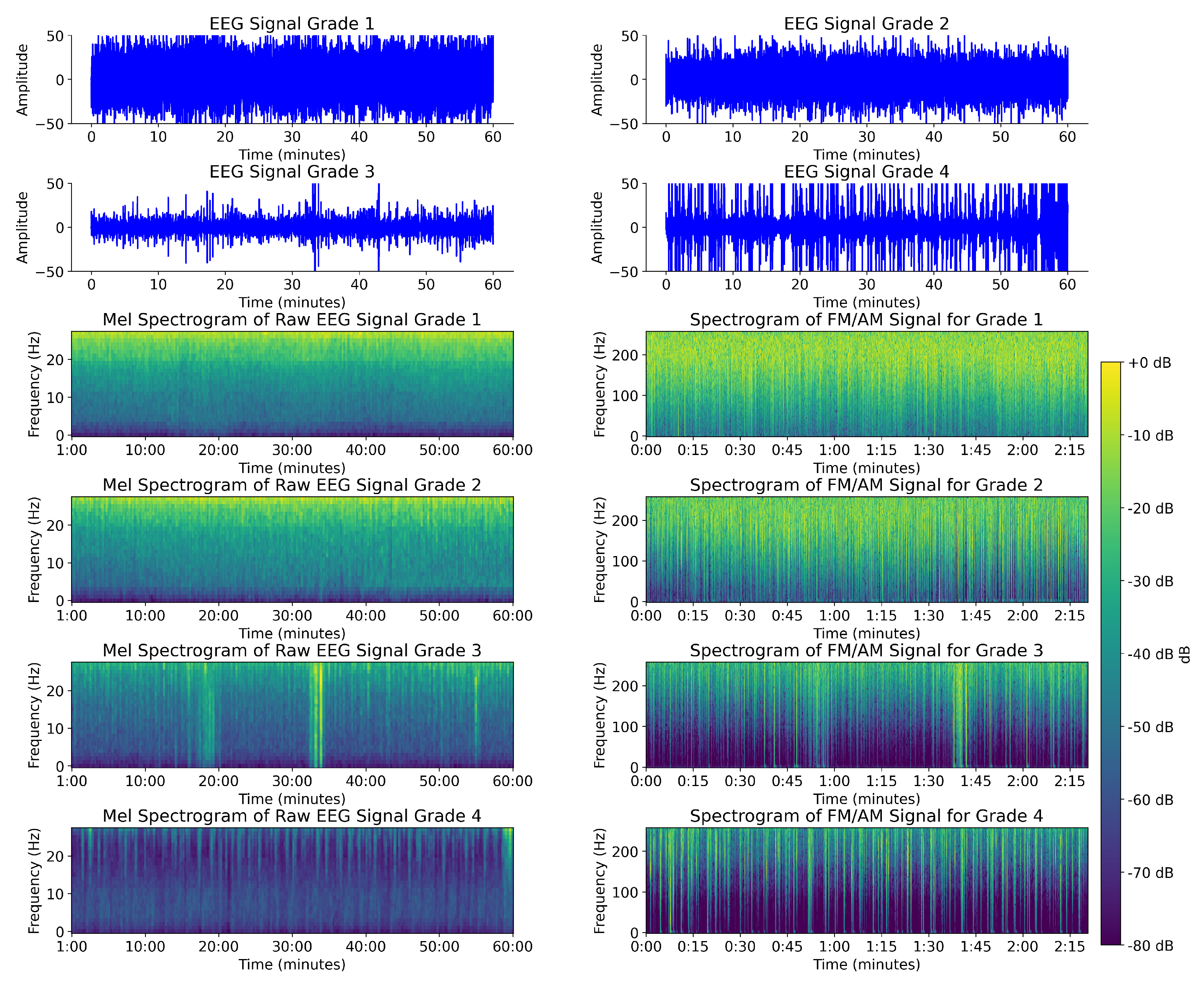 Long-Term Neonatal EEG Modeling with DSP and ML for Grading
