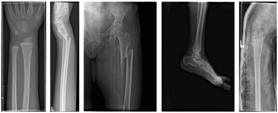 Rehabilitation Driven Optimized YOLOv11 Model for Medical X-Ray