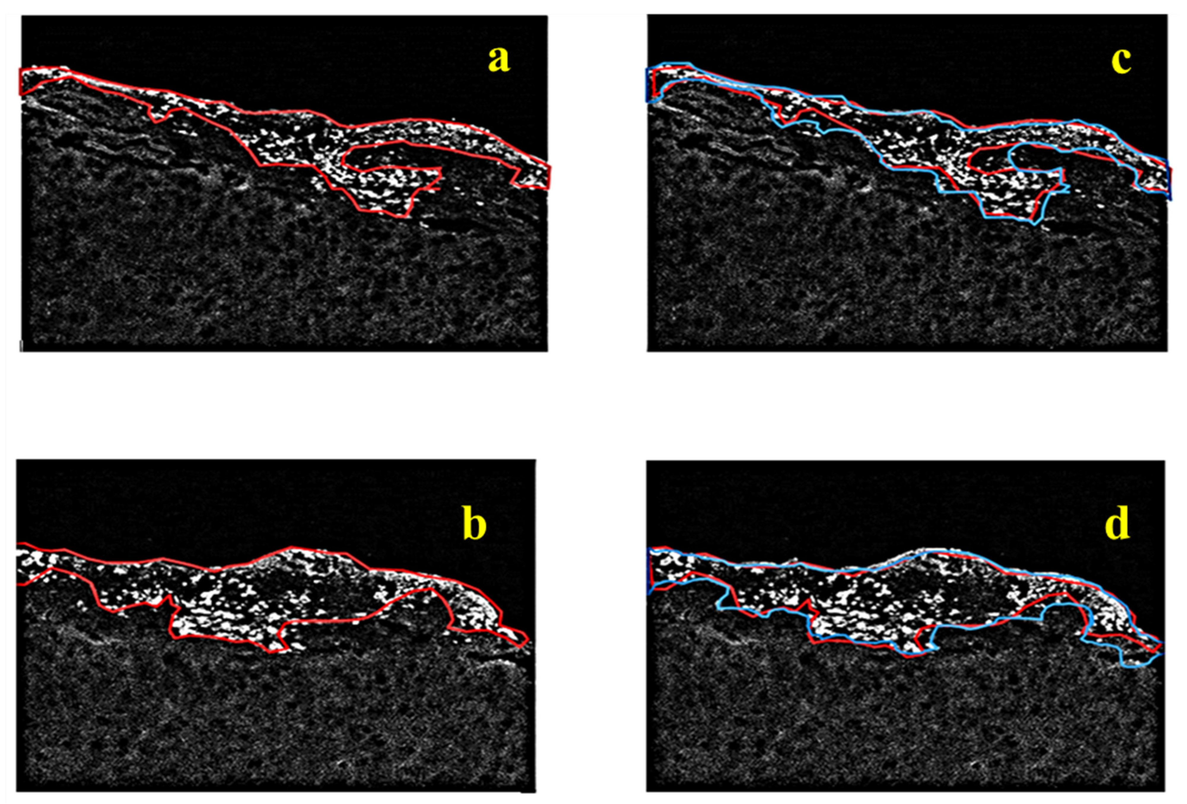 lsm-2004 pimpandhost $nudism peeing Fluorescent Imaging and Multifusion Segmentation for Enhanced Visualization  and Delineation of Glioblastomas Margins