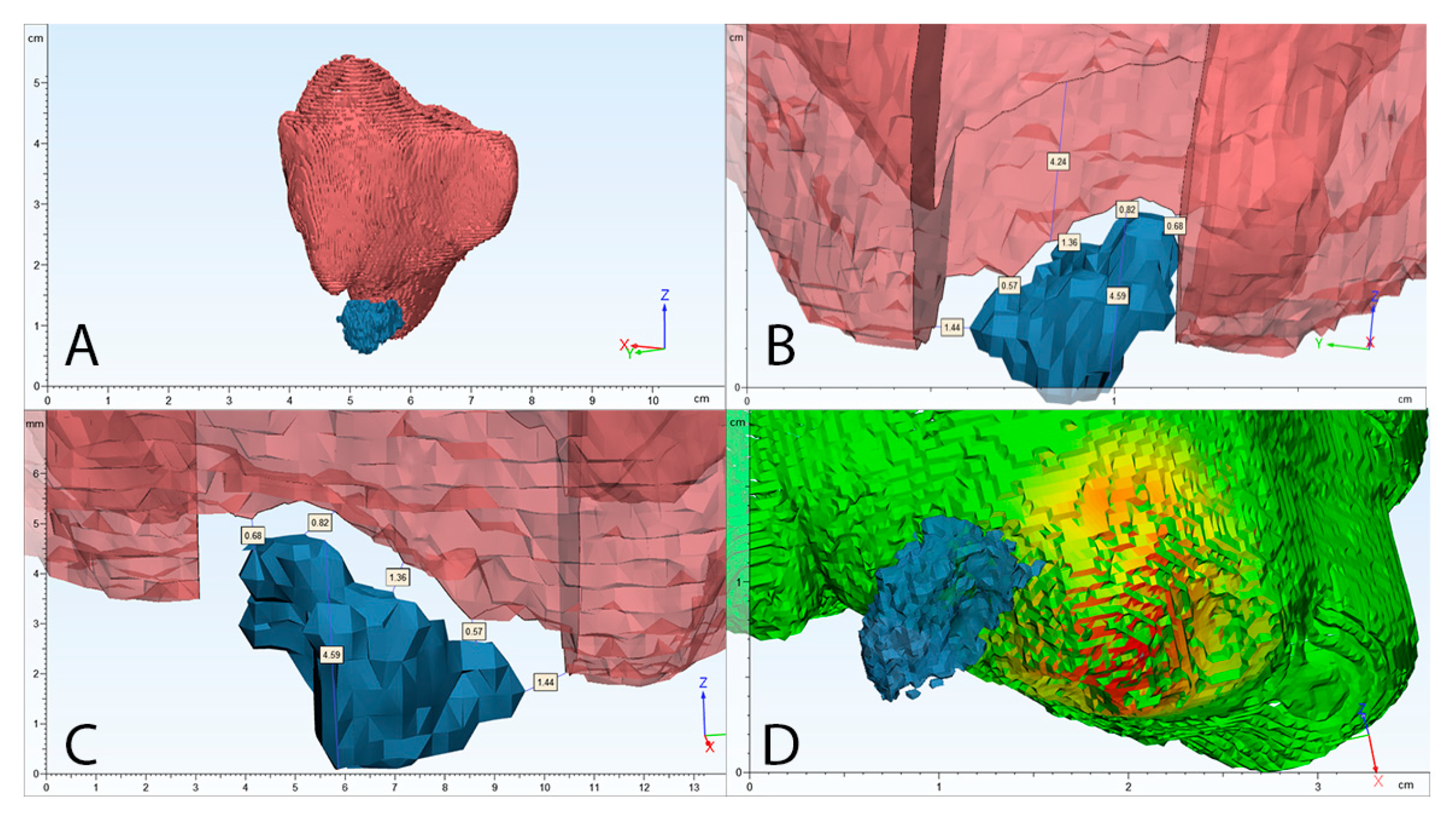 Sinusitis 04 00003 g004 Sinusitis 04 00003 g004