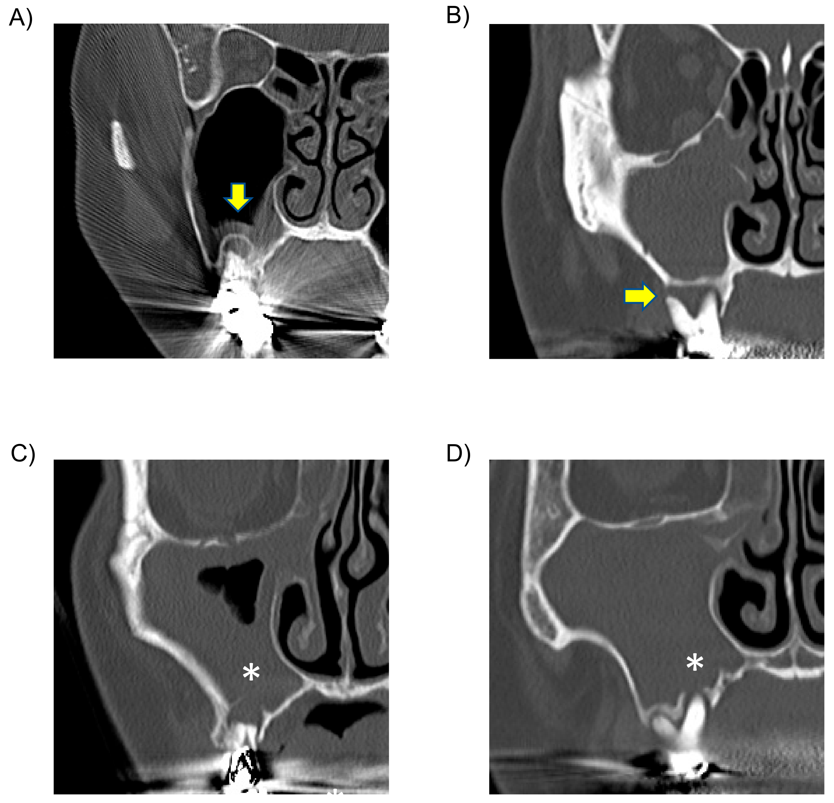 Sinusitis 05 00006 g001 Sinusitis 05 00006 g001