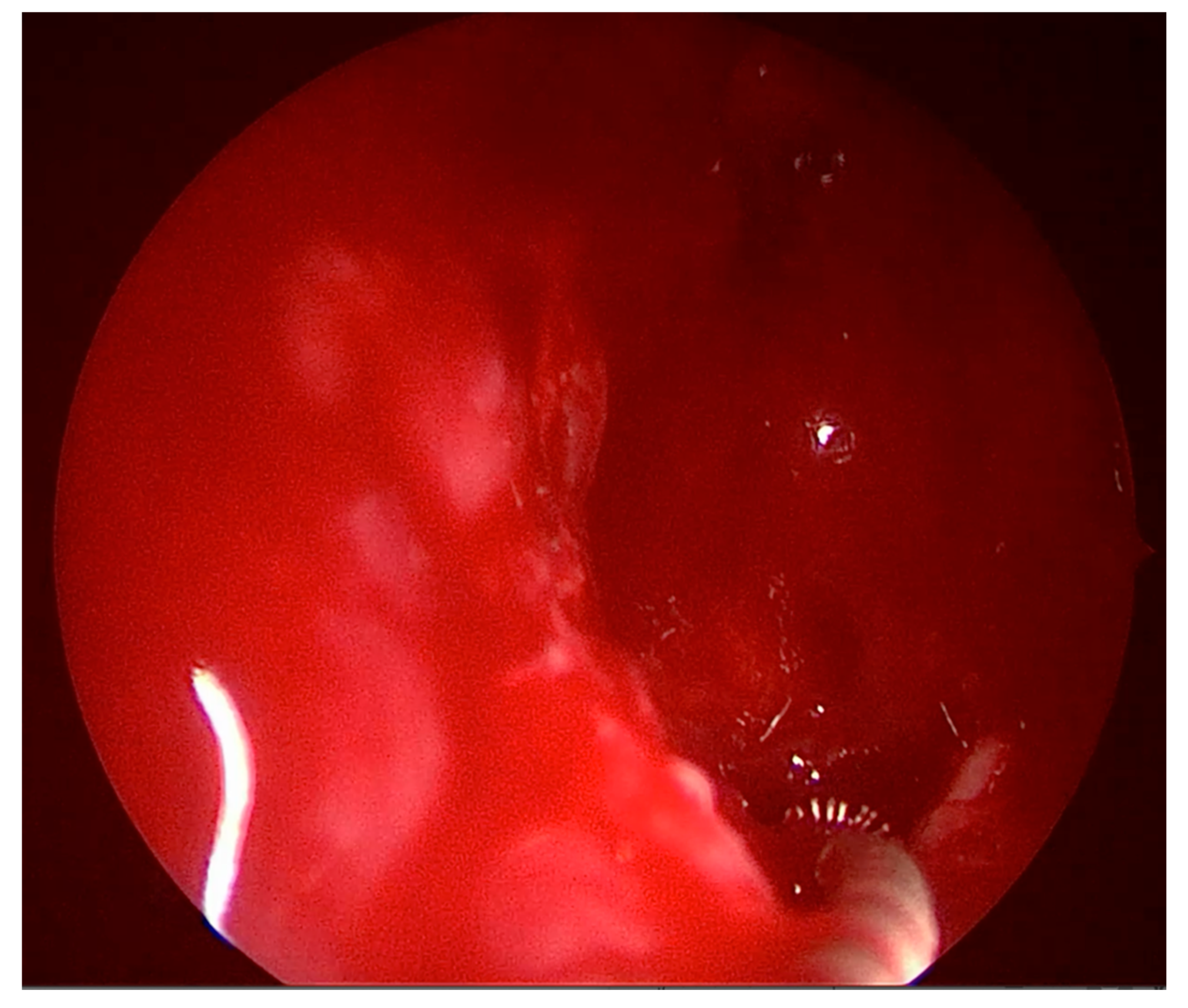 Sinusitis 05 00008 g004 Sinusitis 05 00008 g004
