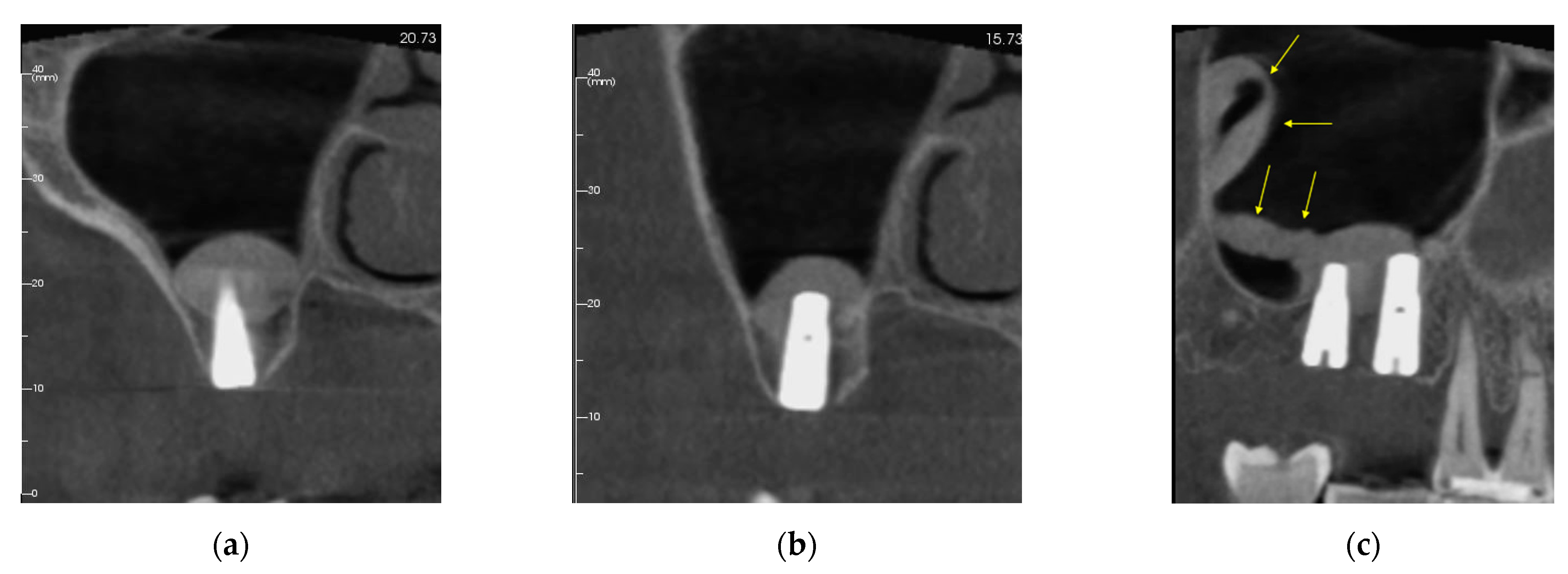 Sinusitis 05 00014 g003 Sinusitis 05 00014 g003