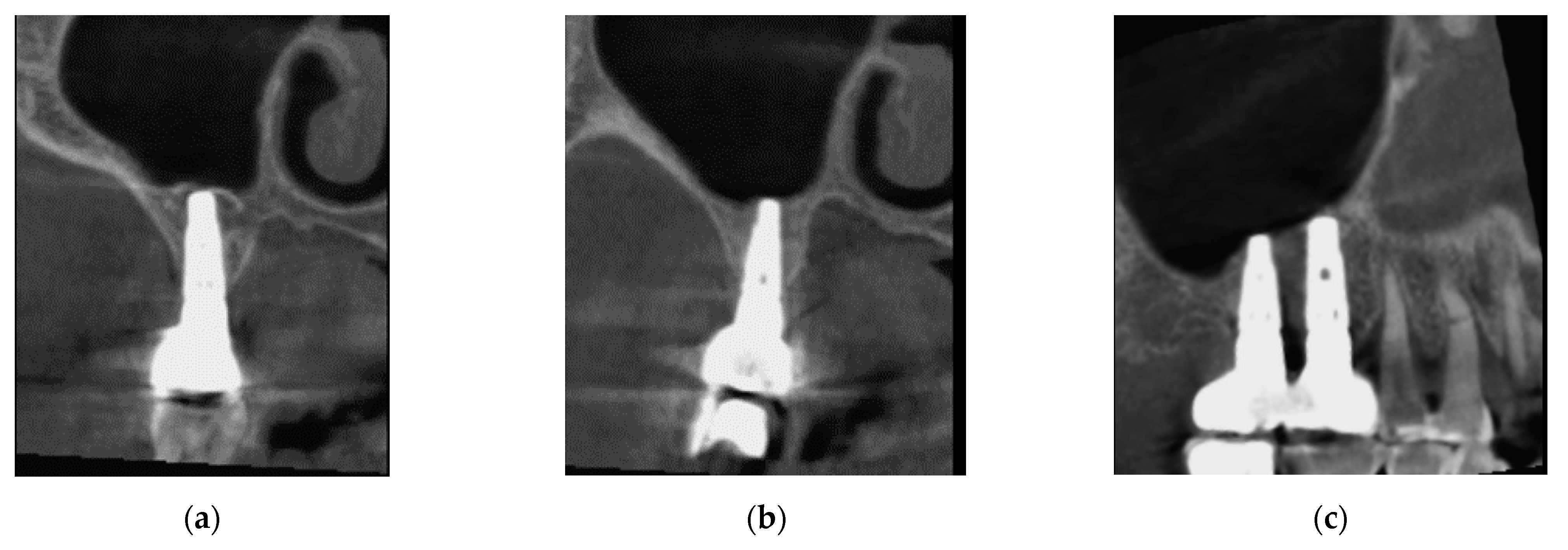 Sinusitis 05 00014 g005 Sinusitis 05 00014 g005