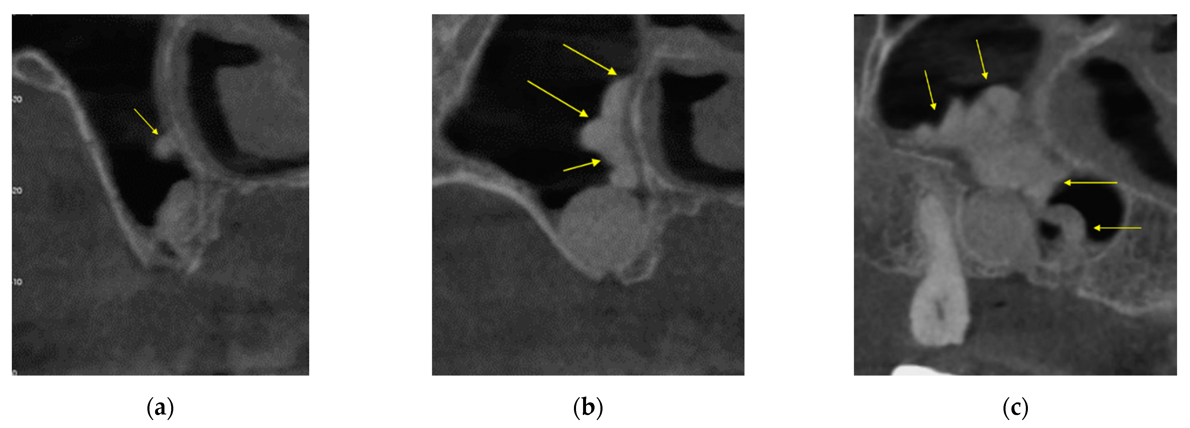 Sinusitis 05 00014 g006 Sinusitis 05 00014 g006