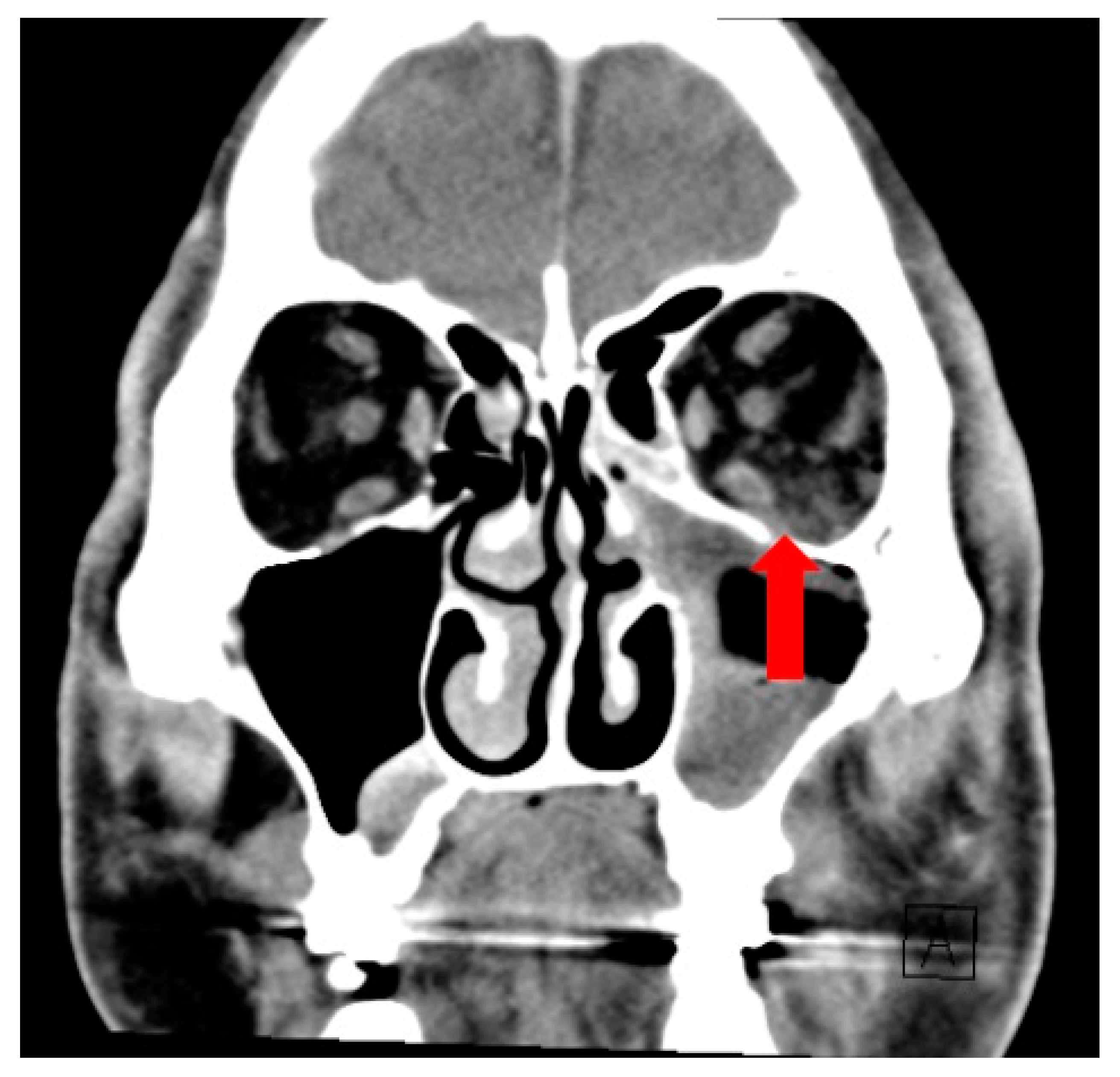 Sinusitis 07 00002 g002
