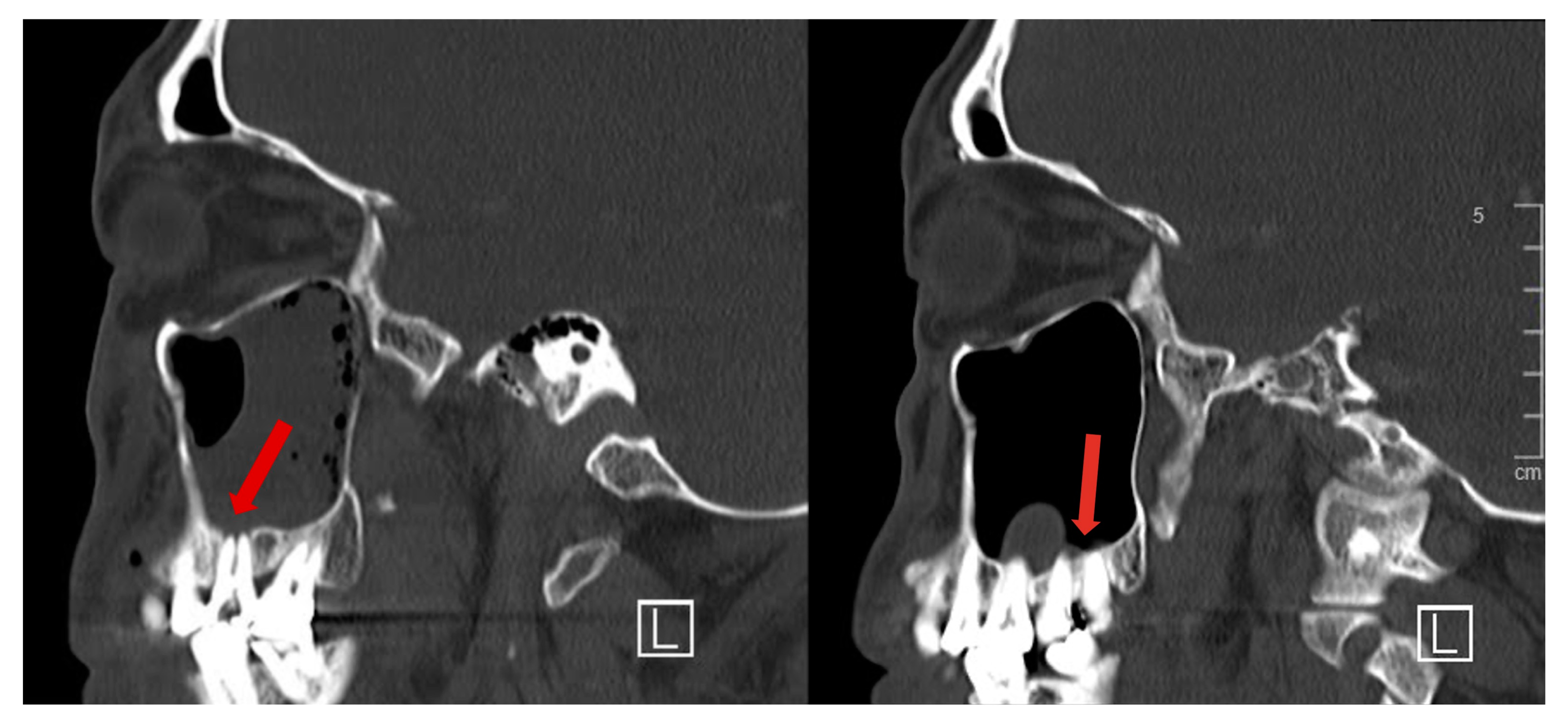 Sinusitis 07 00002 g003
