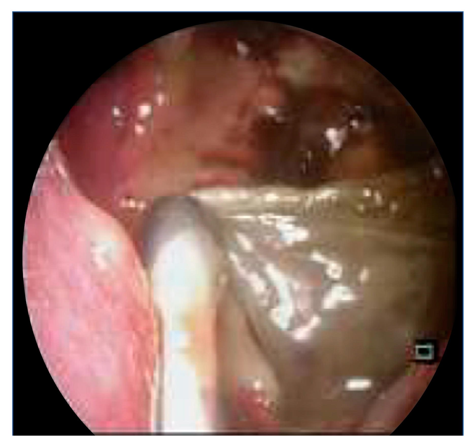 Sinusitis 07 00002 g004