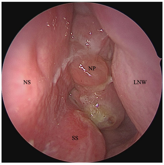 Nasal polyps shop
