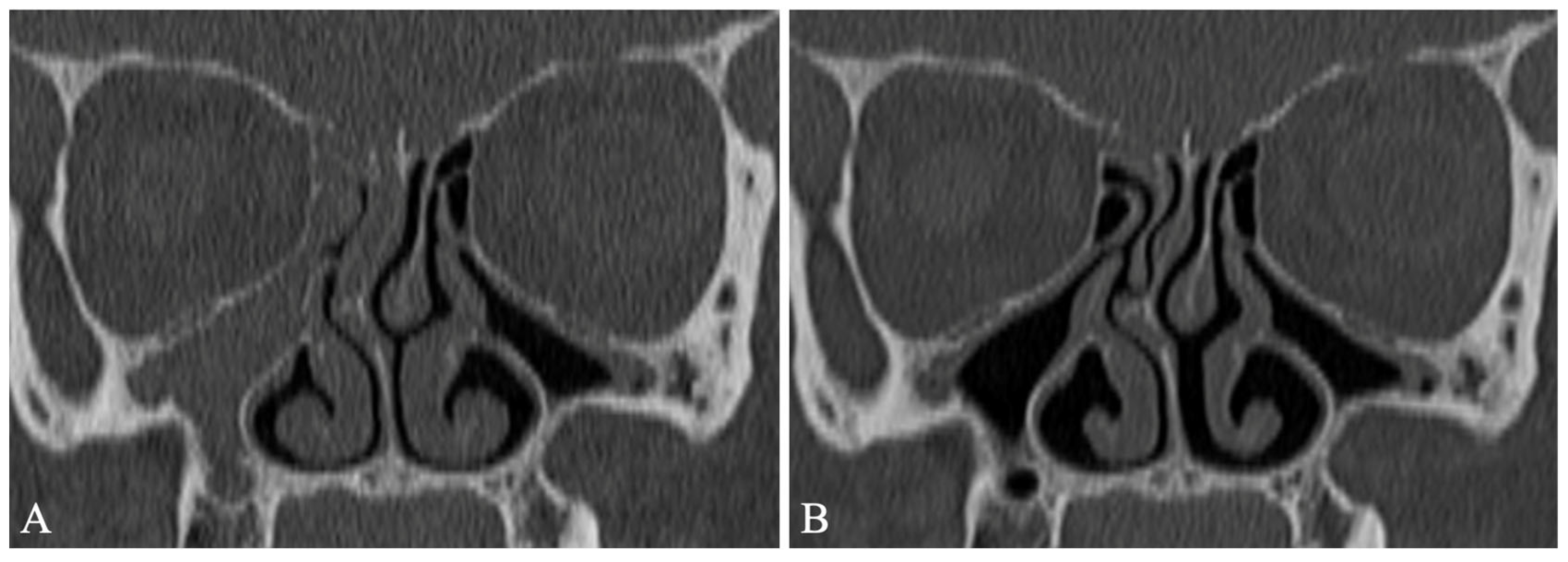 Sinusitis 07 00004 g002