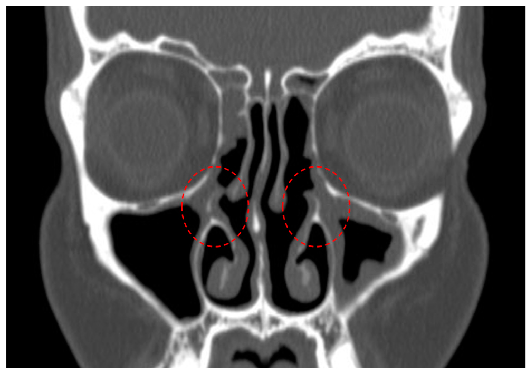 Sinusitis 08 00005 g001 Sinusitis 08 00005 g001