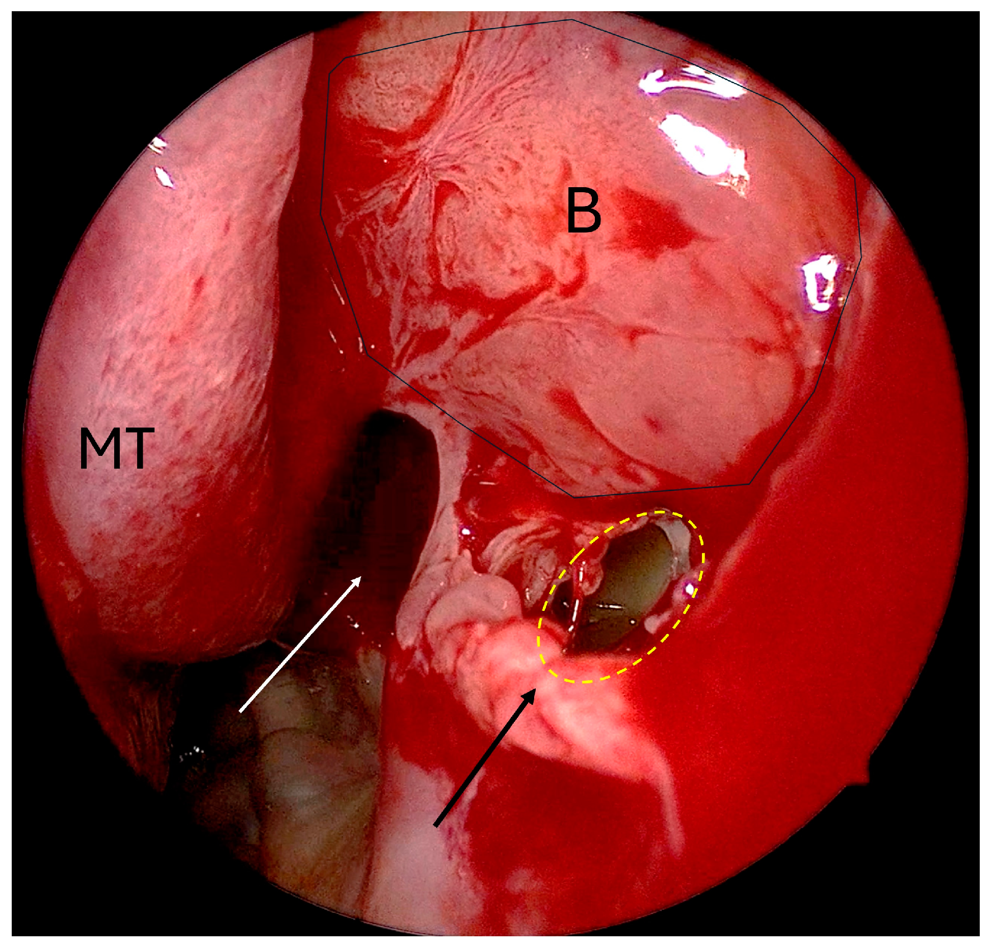 Sinusitis 08 00005 g002 Sinusitis 08 00005 g002