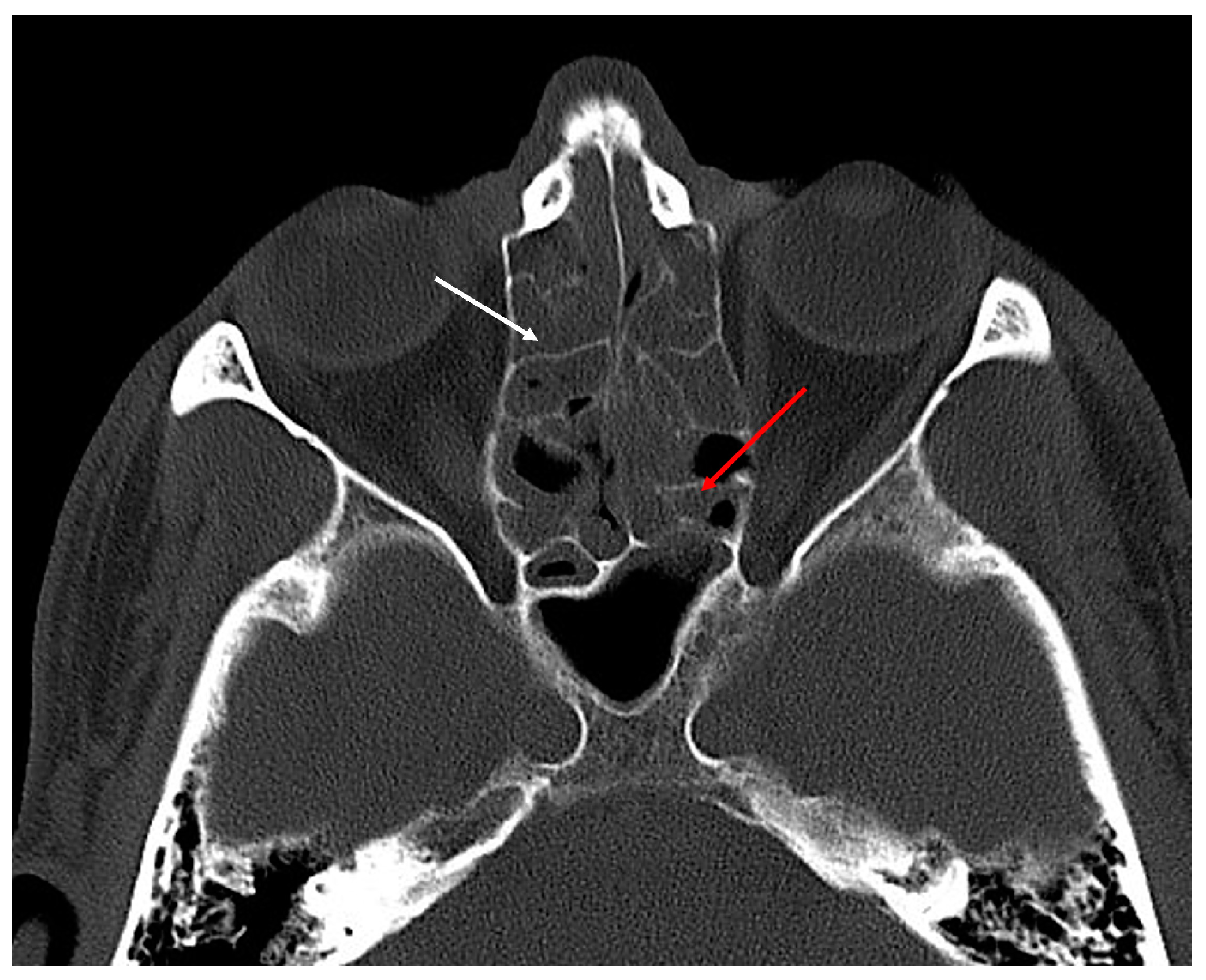 Sinusitis 08 00005 g003 Sinusitis 08 00005 g003