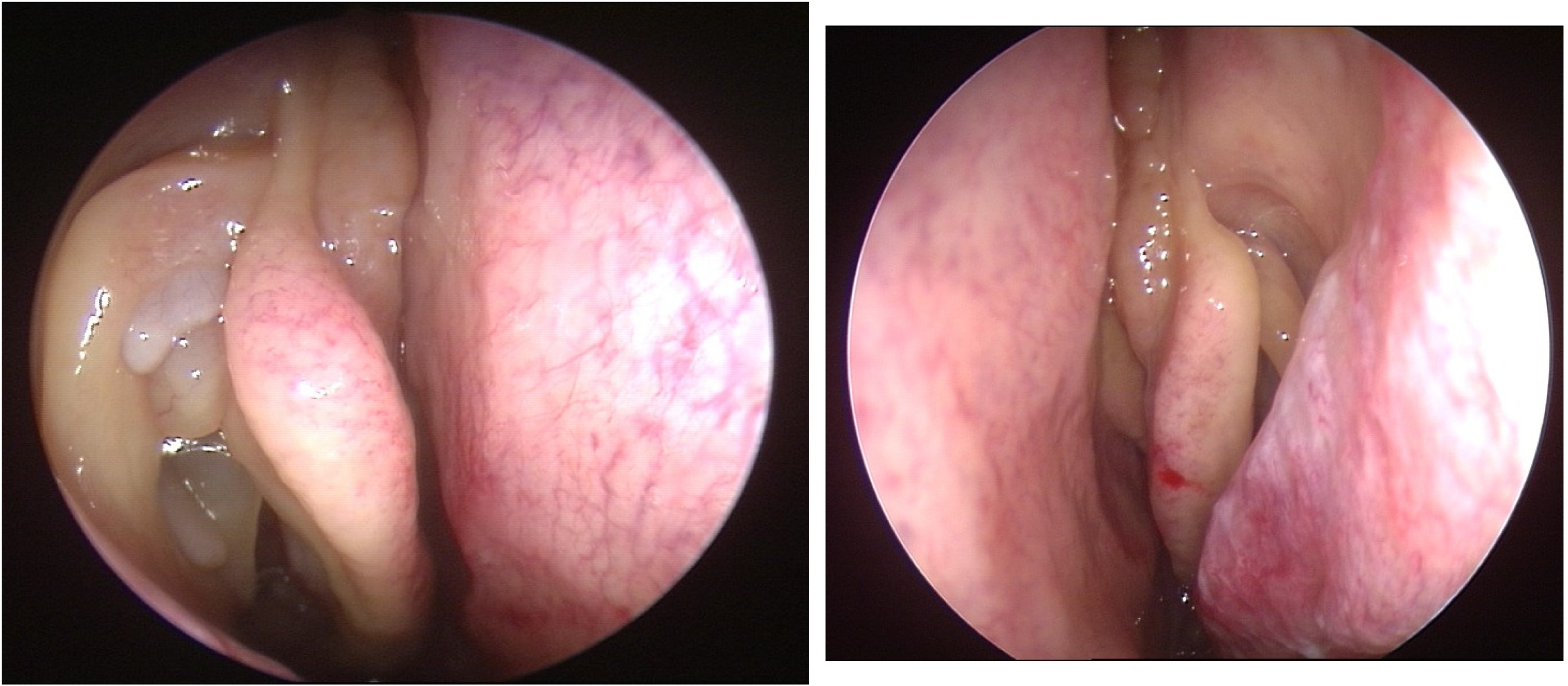 Sinusitis 08 00006 g002 Sinusitis 08 00006 g002