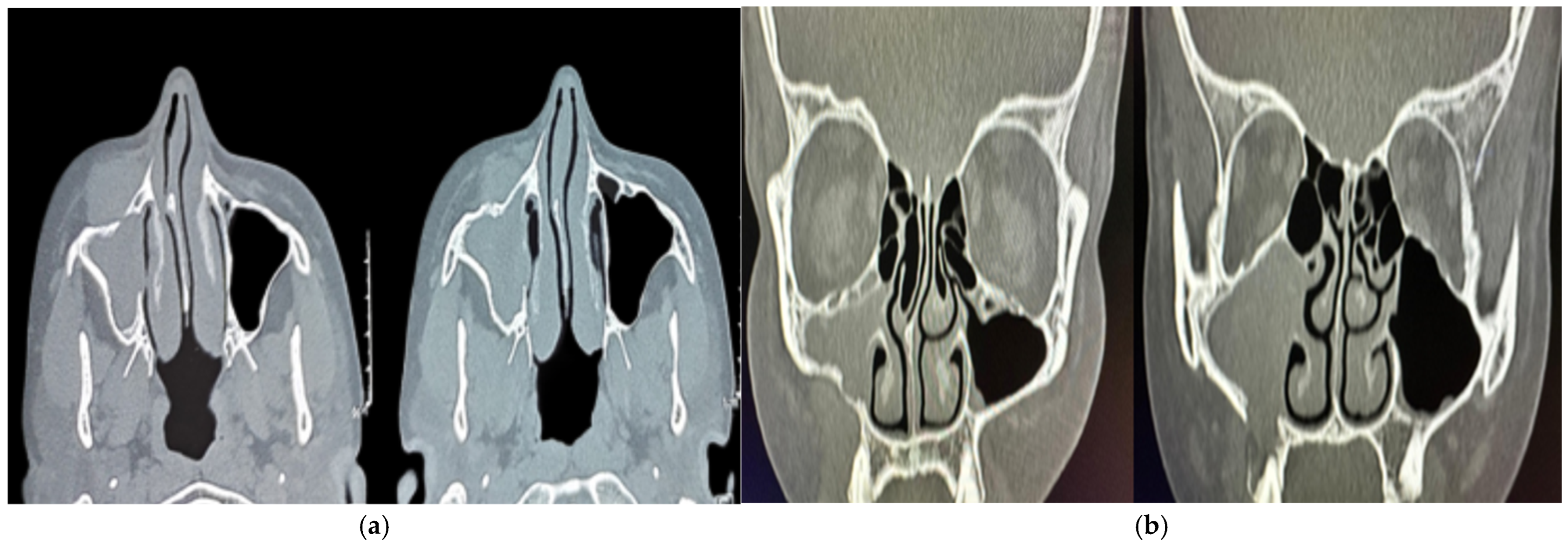 Sinusitis 09 00004 g001