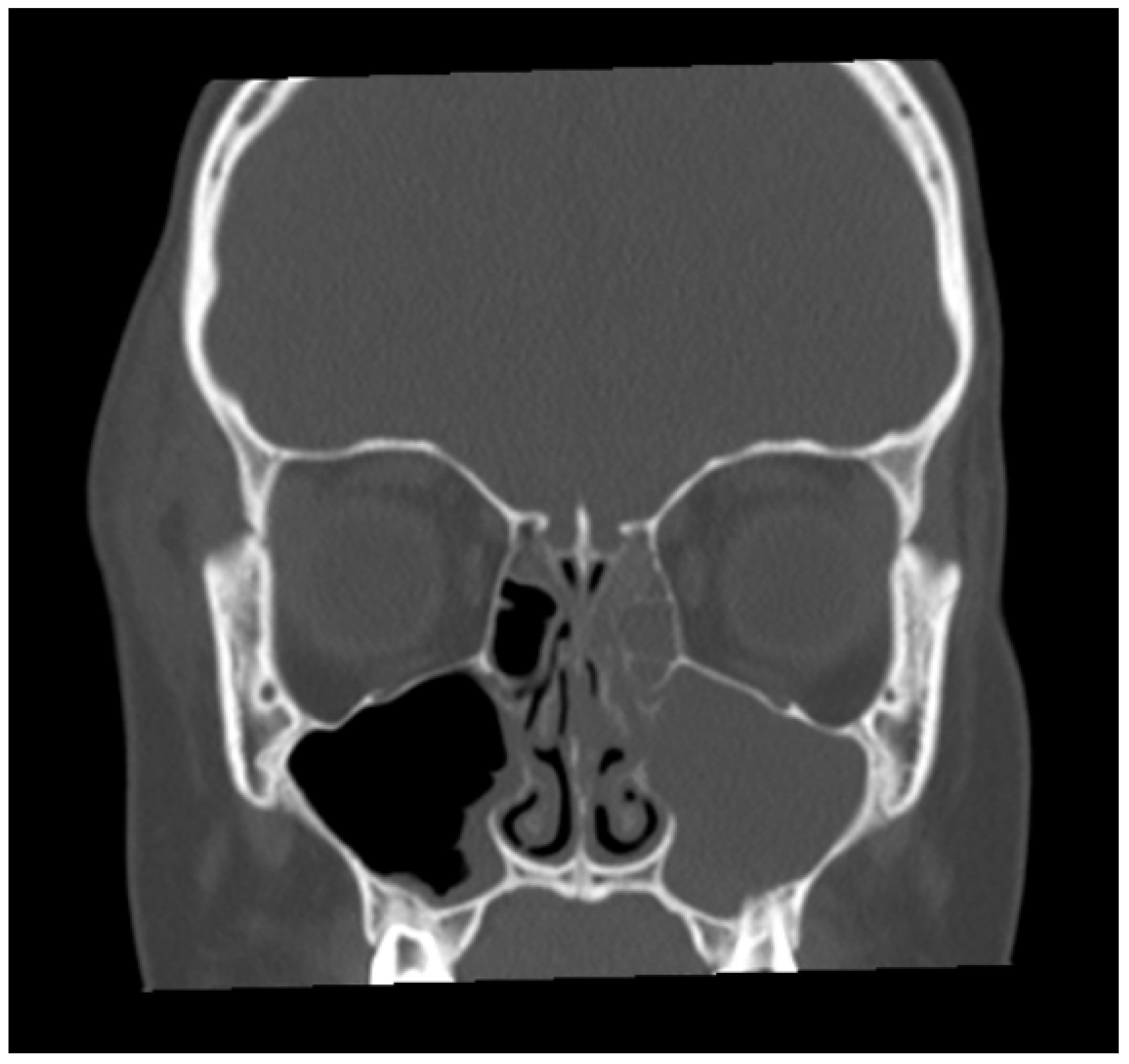 Sinusitis 09 00007 g003