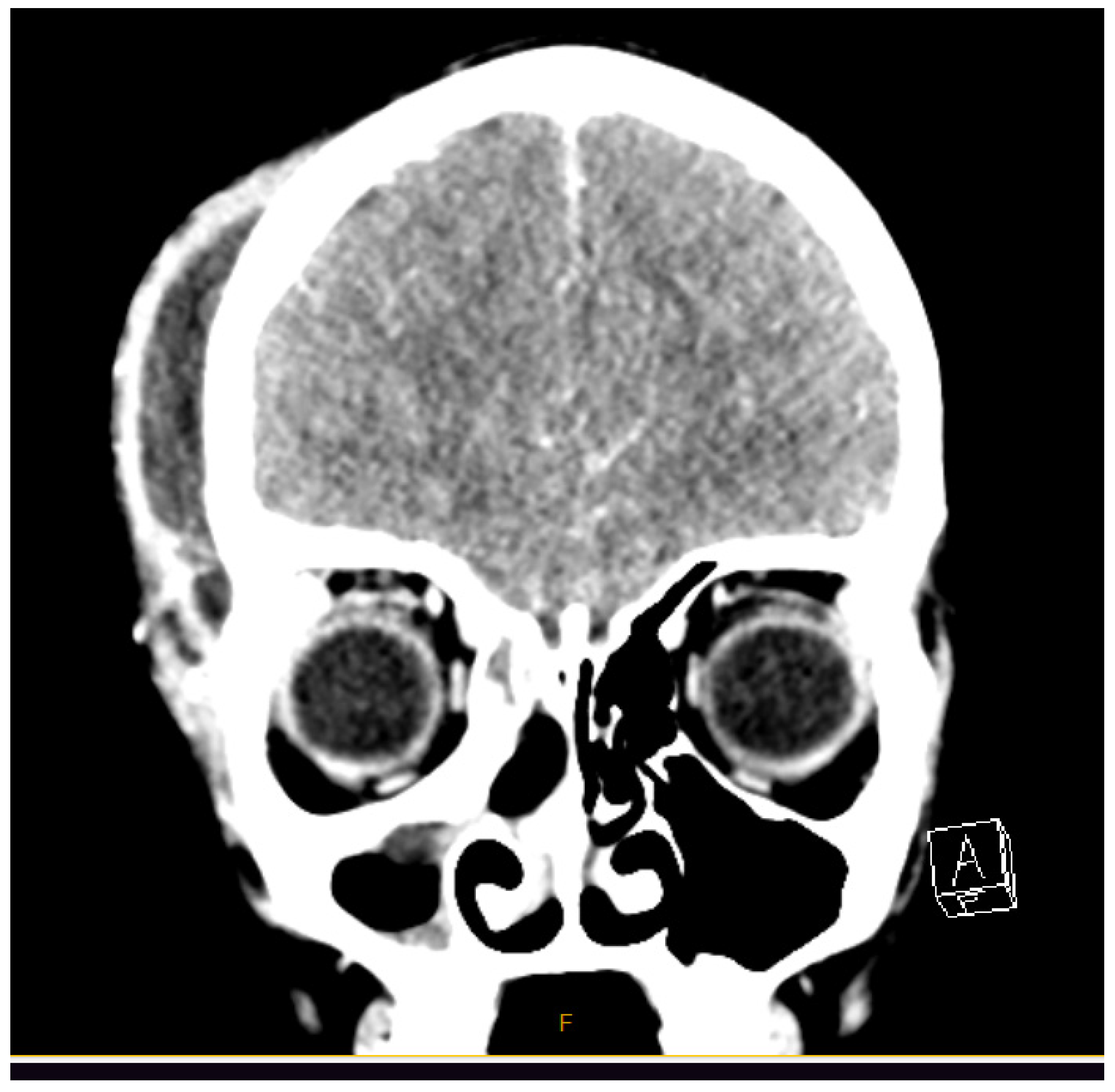 Sinusitis 09 00007 g004
