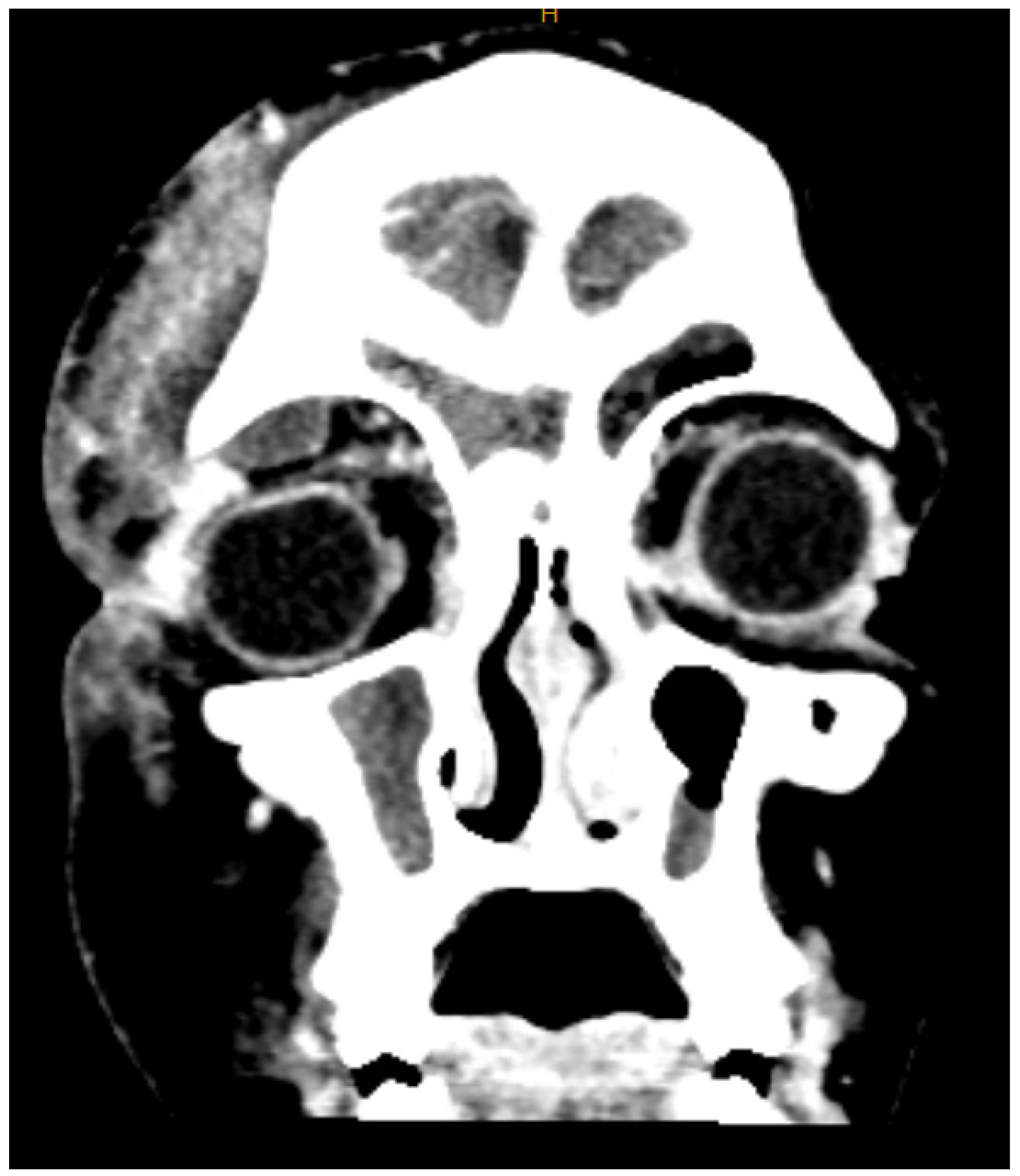 Sinusitis 09 00007 g005