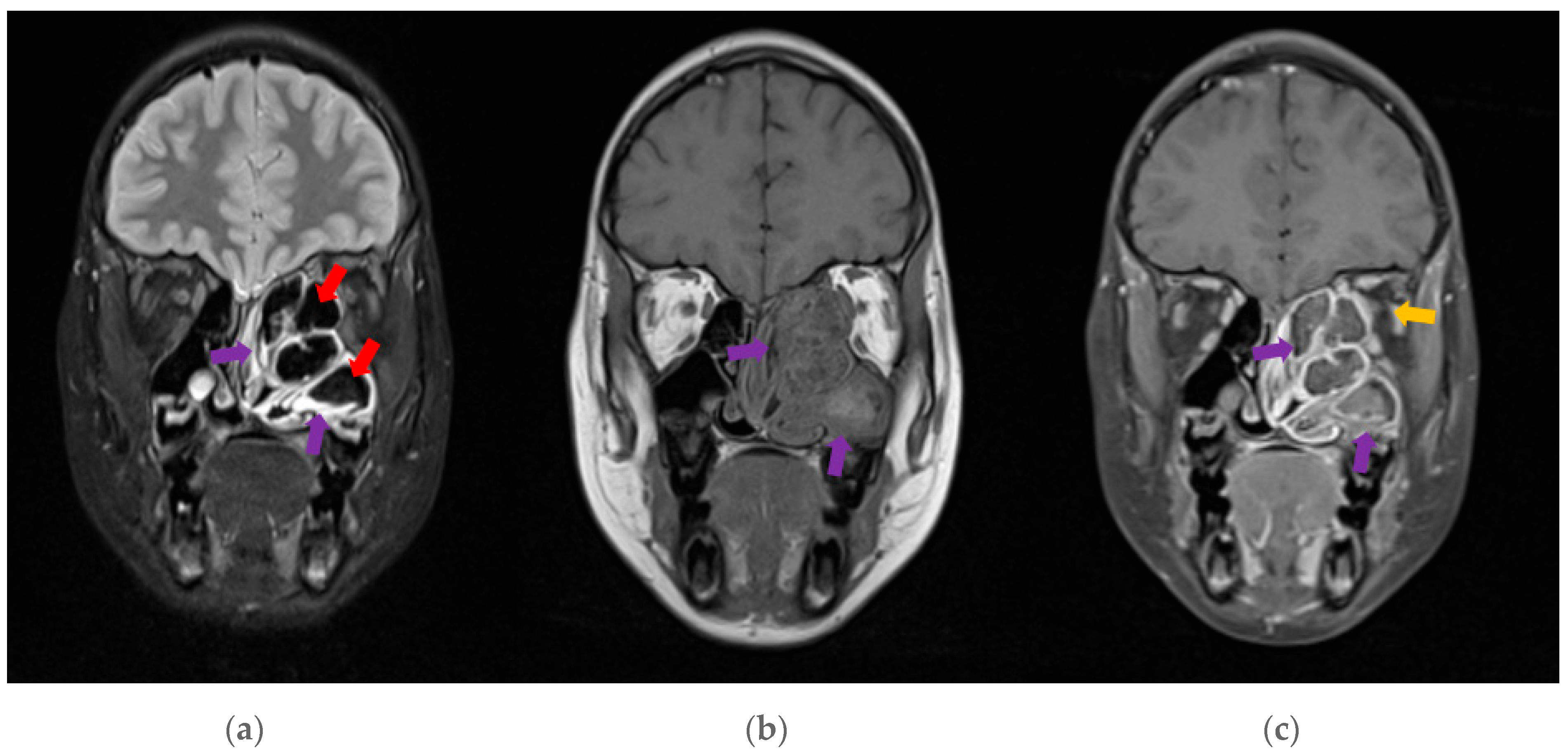 Sinusitis 09 00010 g003