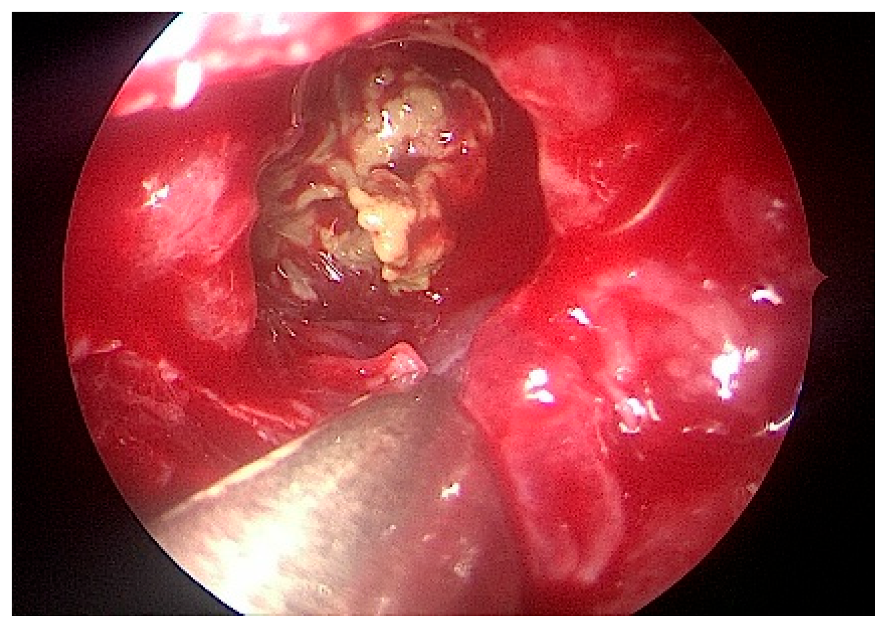 Sinusitis 09 00010 g004