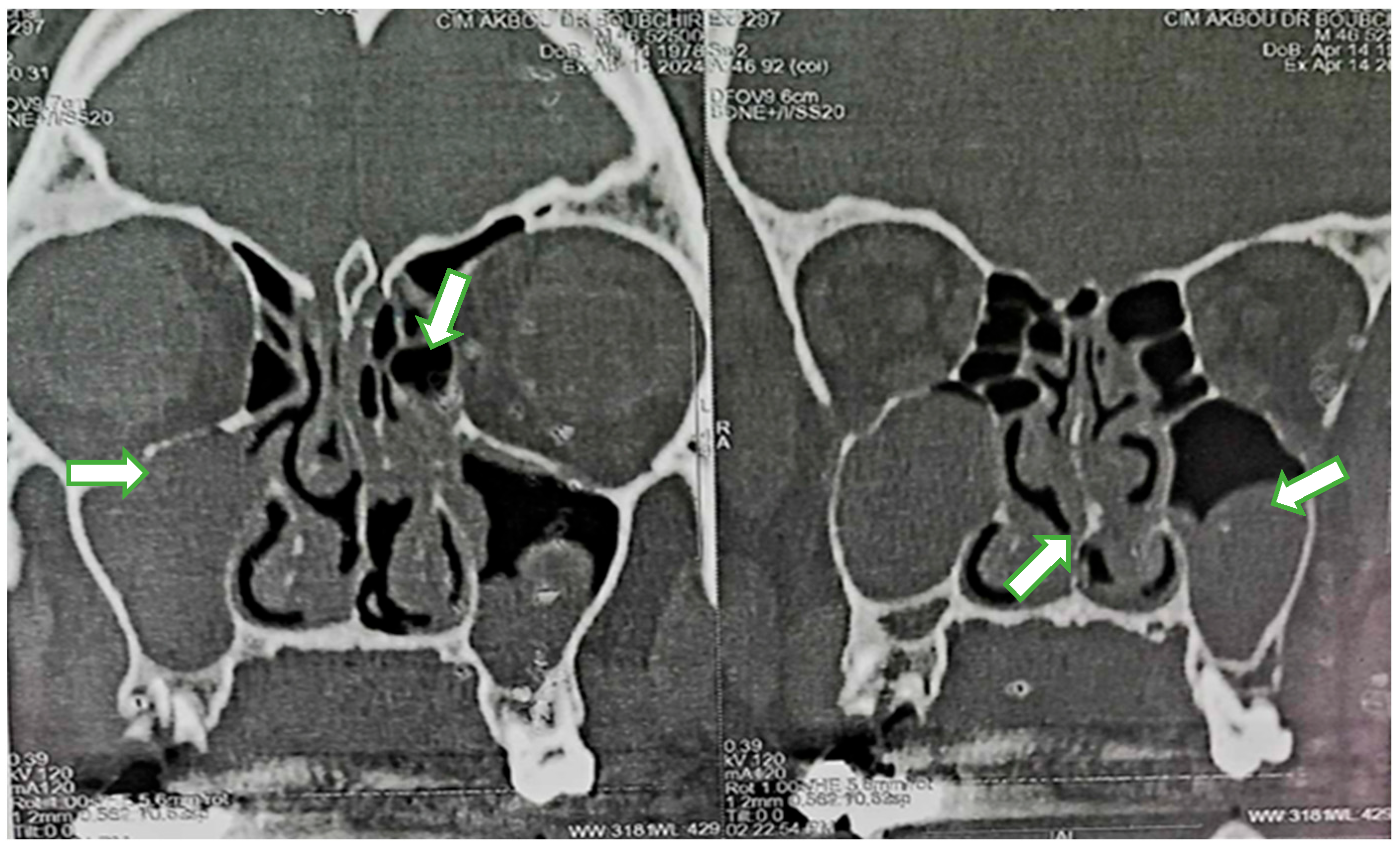 Nasal-Type Natural Killer/T-Cell Extranodal Lymphoma