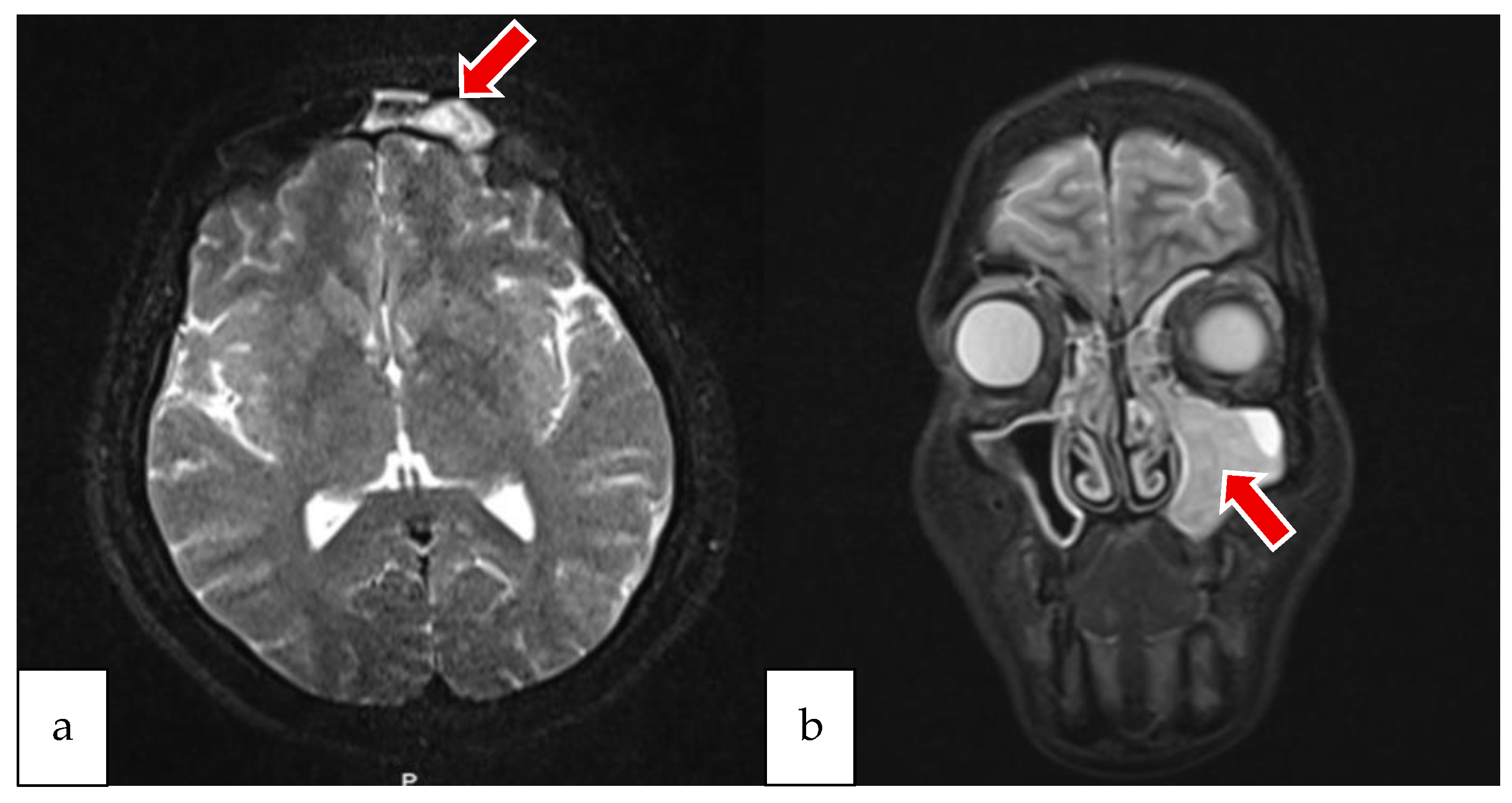 Sinusitis 09 00022 g003 Sinusitis 09 00022 g003