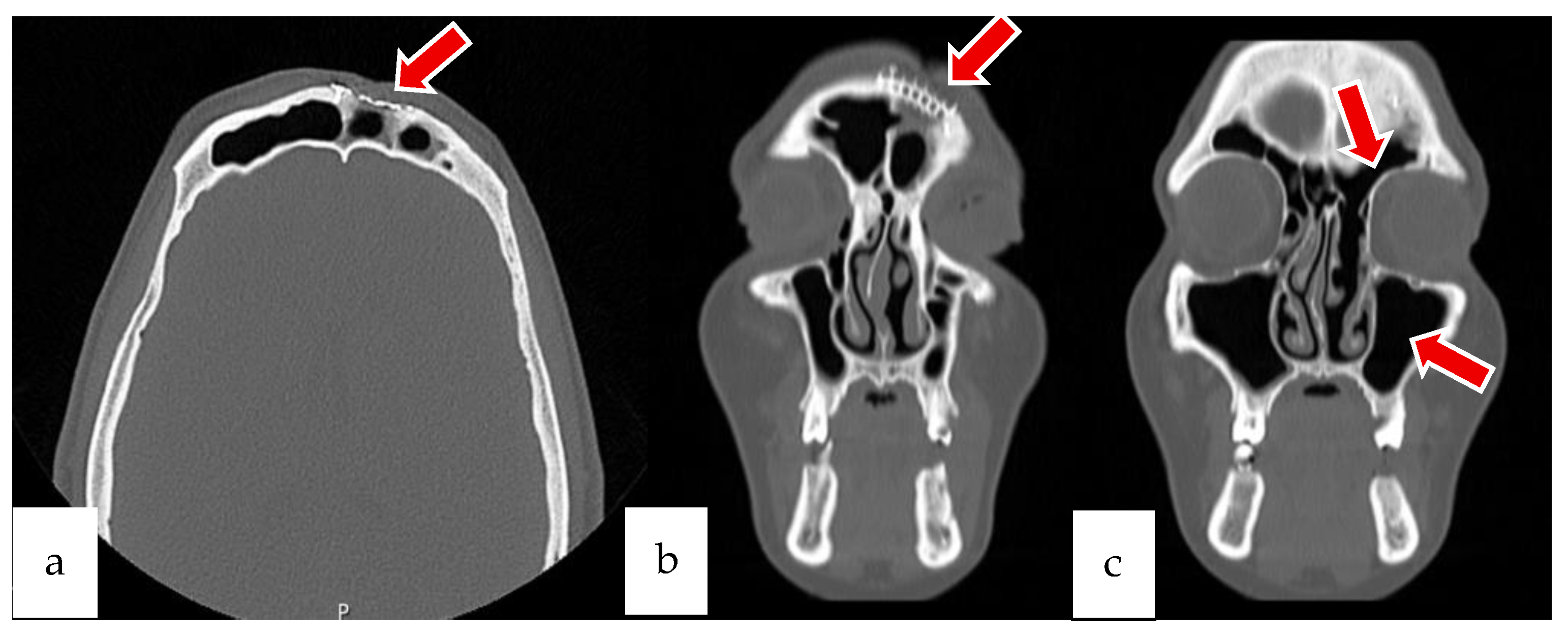 Sinusitis 09 00022 g008 Sinusitis 09 00022 g008