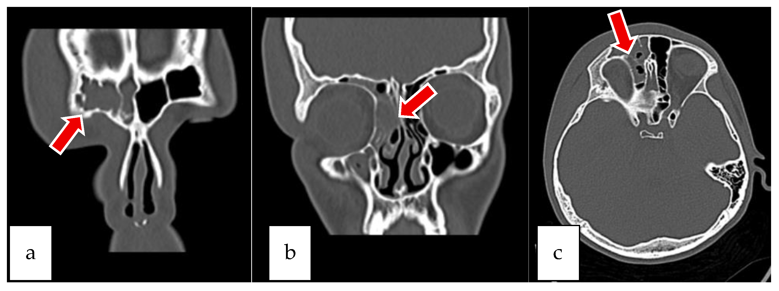 Sinusitis 09 00022 g011 Sinusitis 09 00022 g011