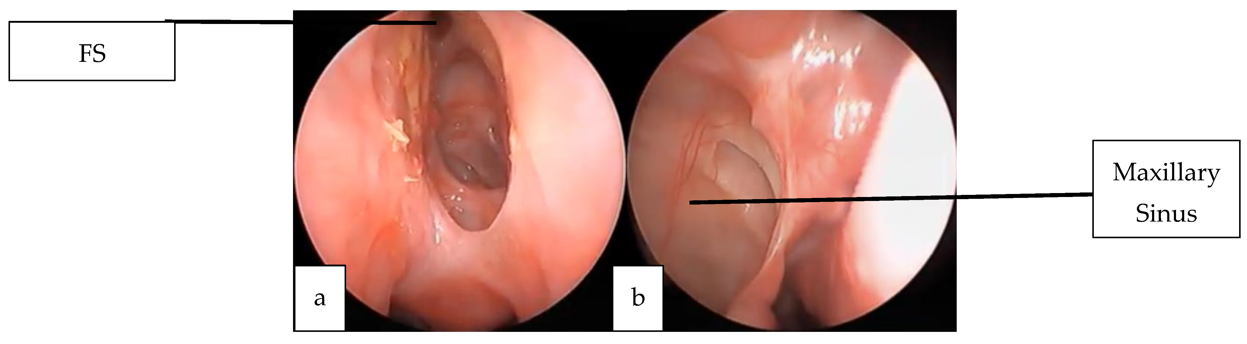 Sinusitis 09 00022 g015 Sinusitis 09 00022 g015