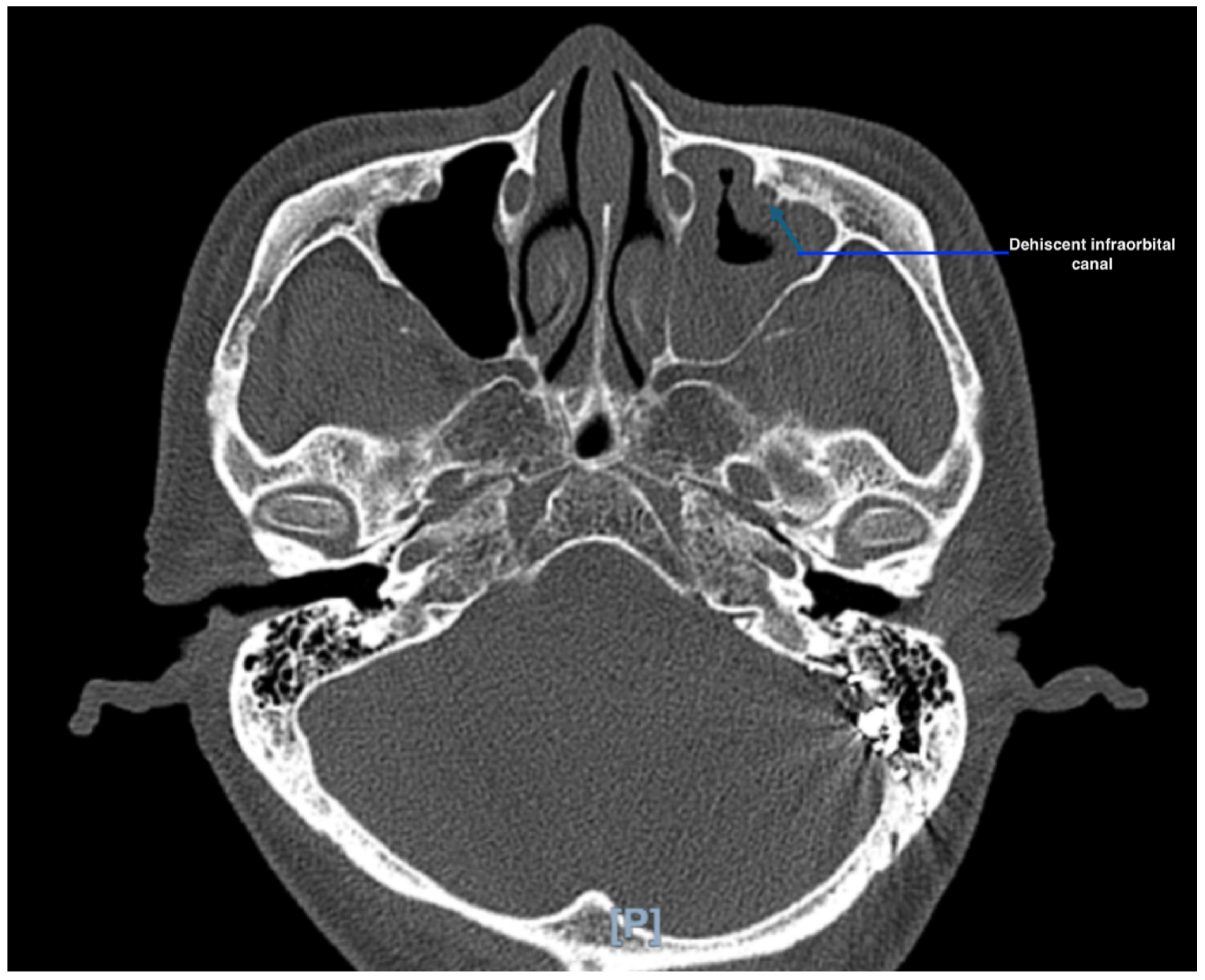 Sinusitis 10 00004 g002
