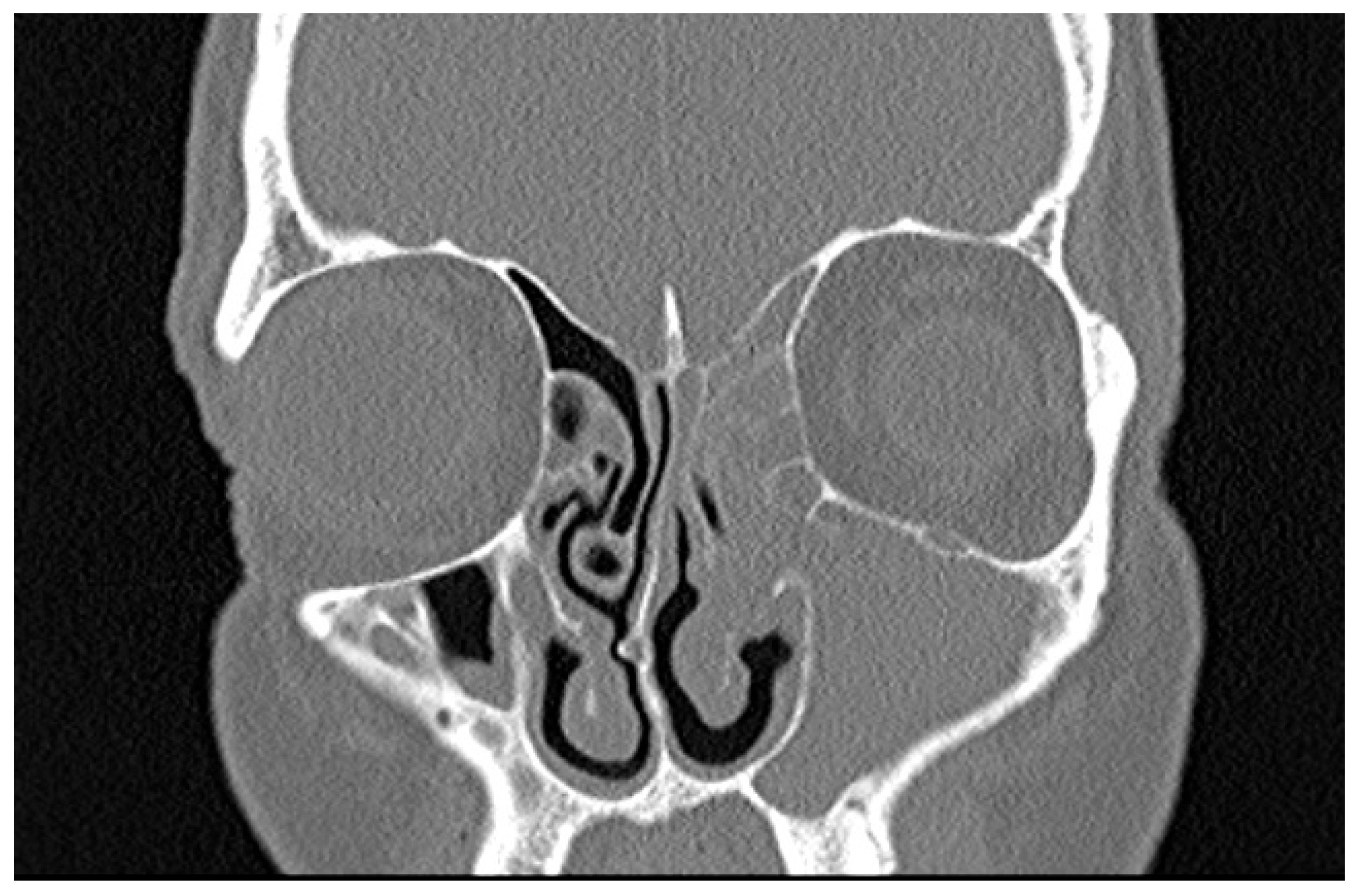 Sinusitis 10 00007 g003