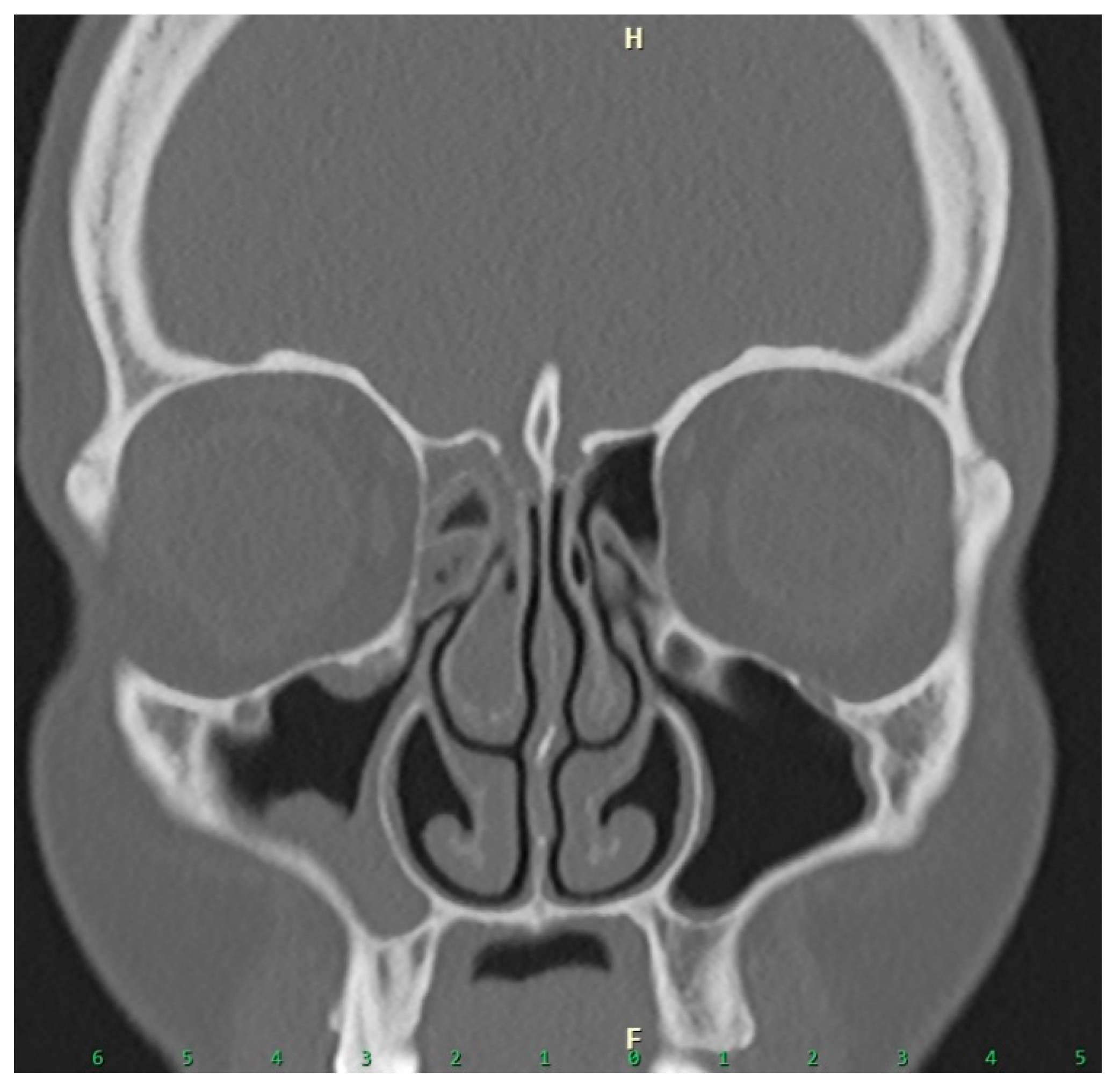 Sinusitis 10 00007 g004