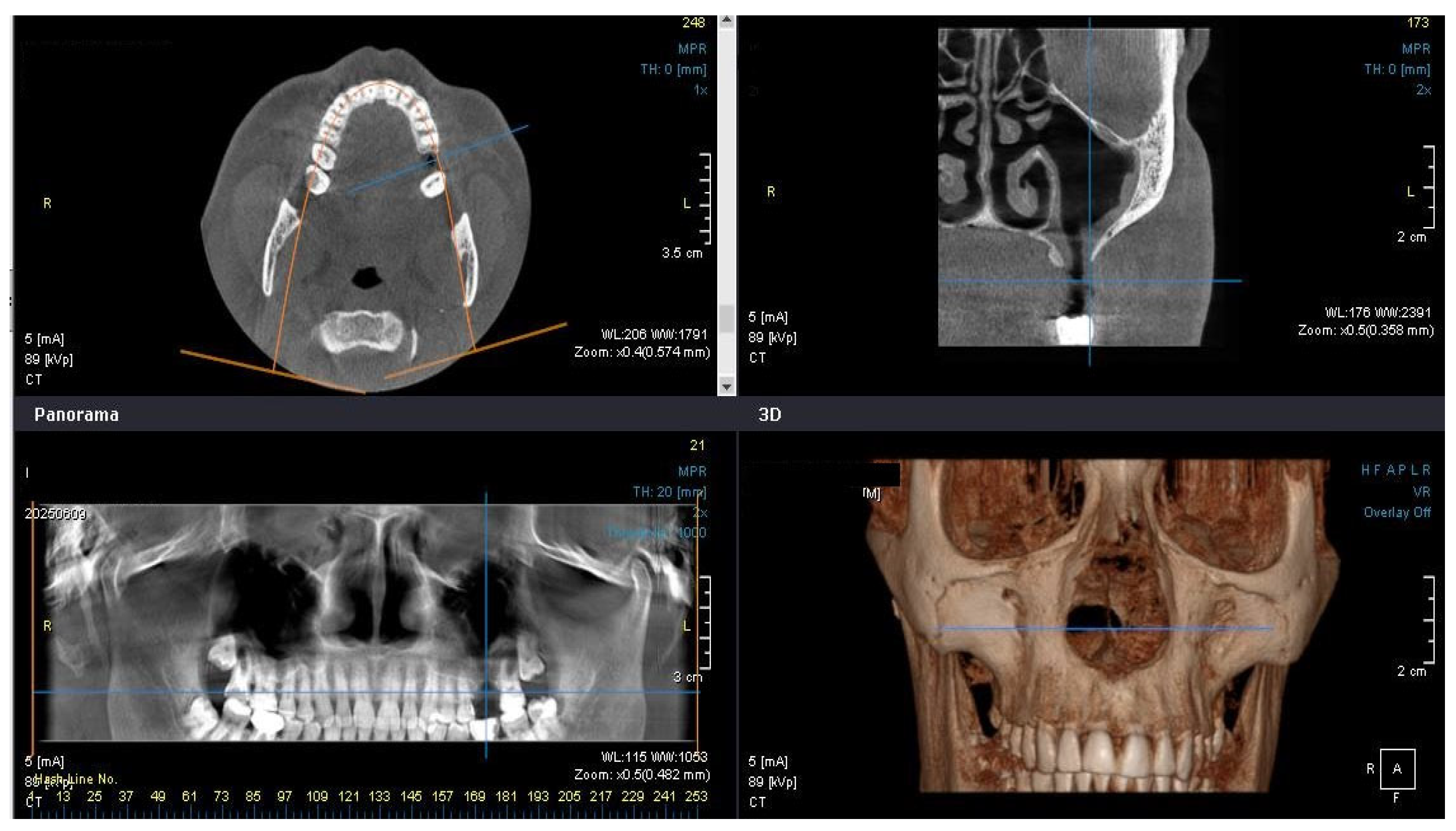 Sinusitis 10 00014 g006 Sinusitis 10 00014 g006