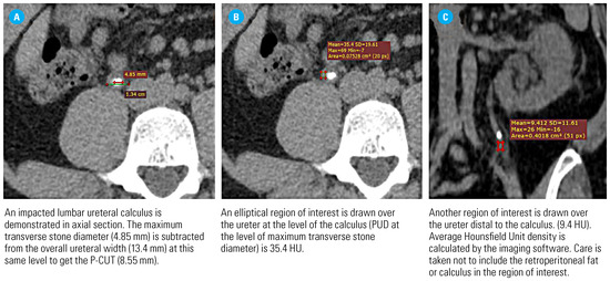 Predictors for Retrograde Ureteral Stenting Failure as an Initial 