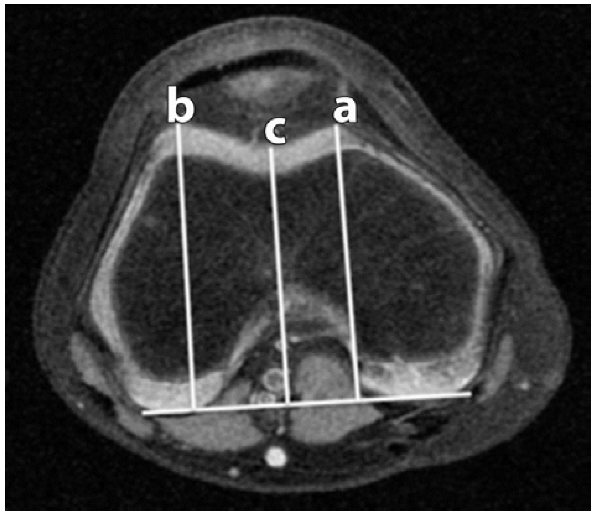 Sports Free Full Text Radiographic Assessment of Anatomic Risk