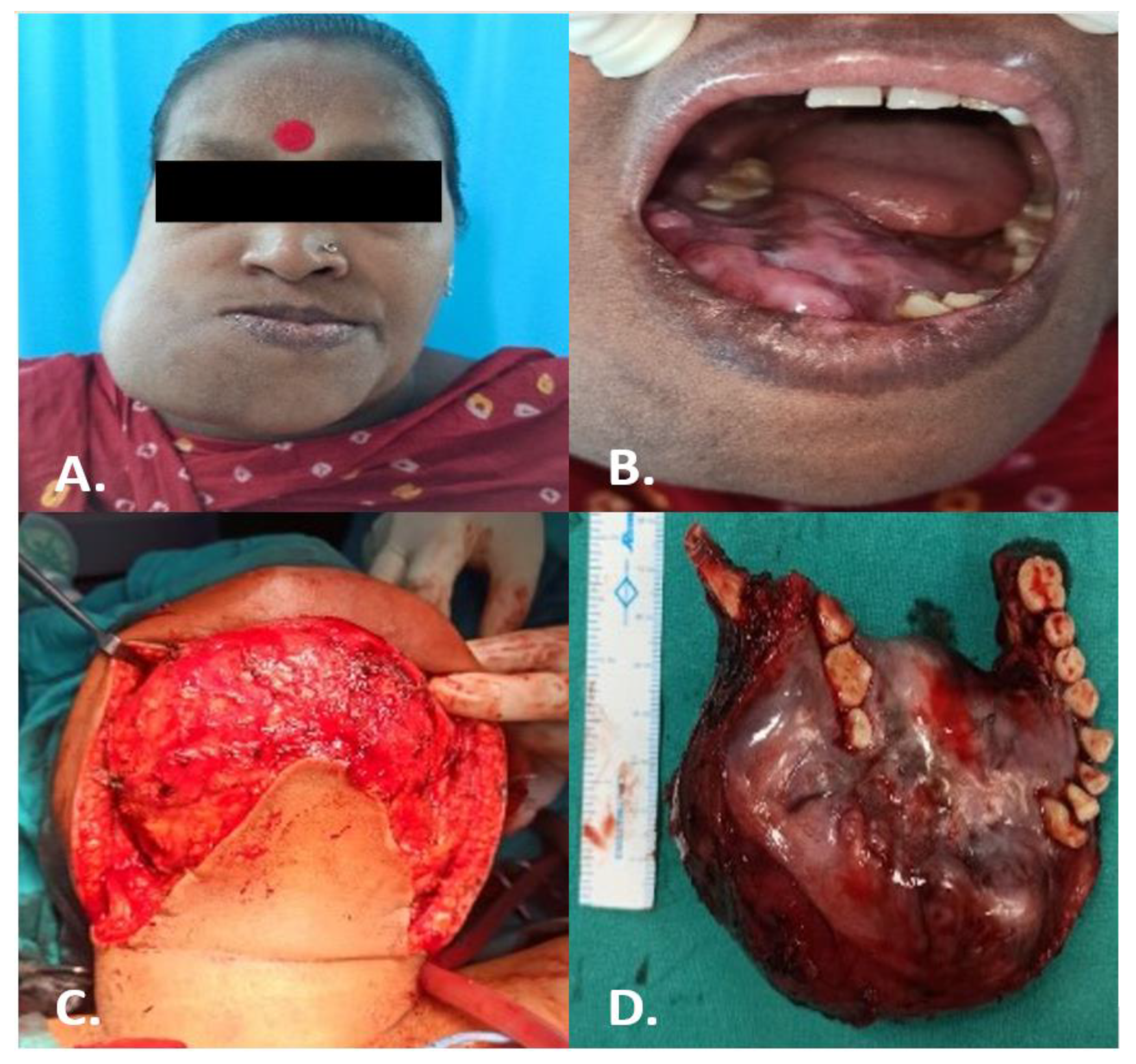 Surgical Techniques Development | Free Full-Text | Custom-Made 3D Titanium  Plate for Mandibular Reconstruction in Surgery of Ameloblastoma: A Novel  Case Report