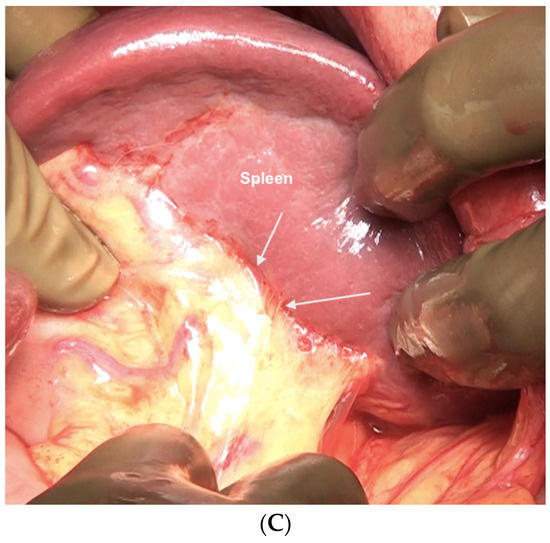 Upper-Abdominal Cytoreduction for Advanced Ovarian Cancer Upper-Abdominal Cytoreduction for Advanced Ovarian Cancer