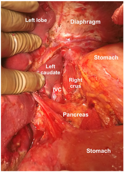 Upper-Abdominal Cytoreduction for Advanced Ovarian Cancer Upper-Abdominal Cytoreduction for Advanced Ovarian Cancer