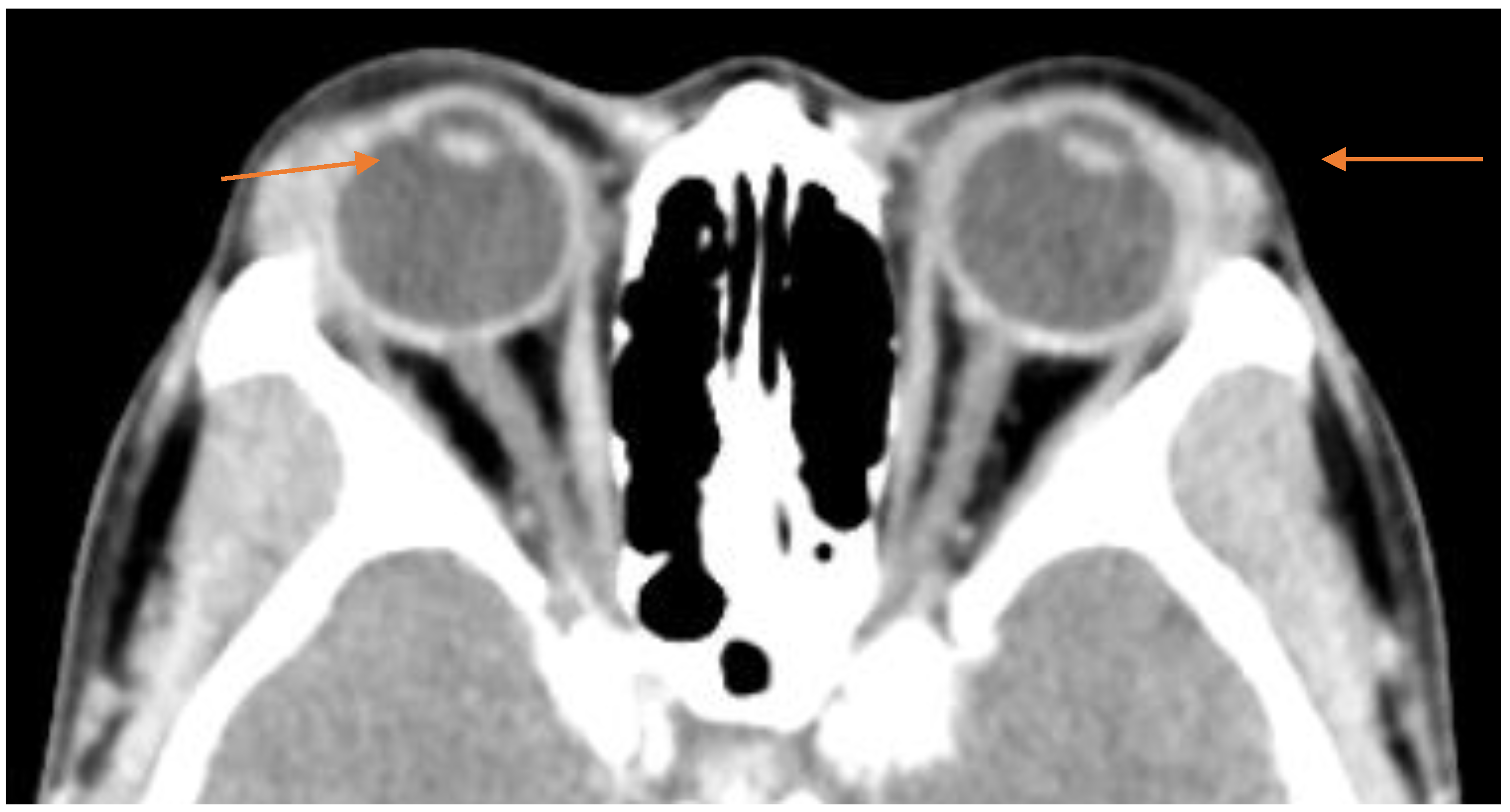 Surgical Techniques Development Free Full Text Lacrimal Gland surgical-techniques-development-free-full-text-lacrimal-gland