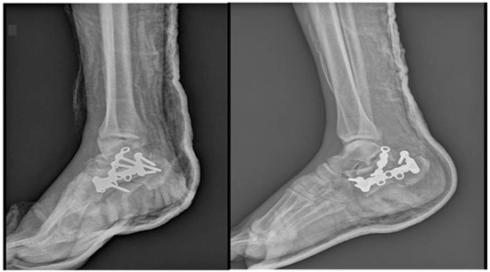 Island Pedicle Flaps as a Suitable Method of Treatment in the