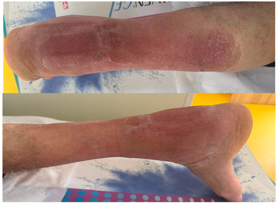 Island Pedicle Flaps as a Suitable Method of Treatment in the