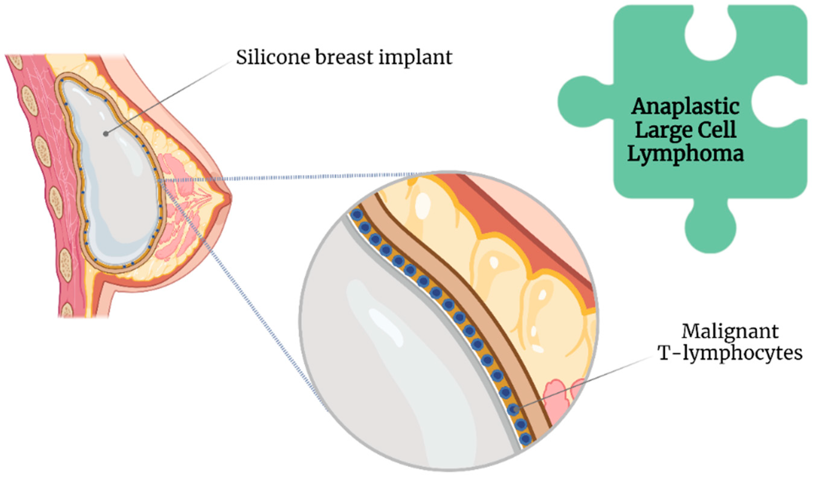 Advantages and Disadvantages of Silicone Breast Implants - Ali