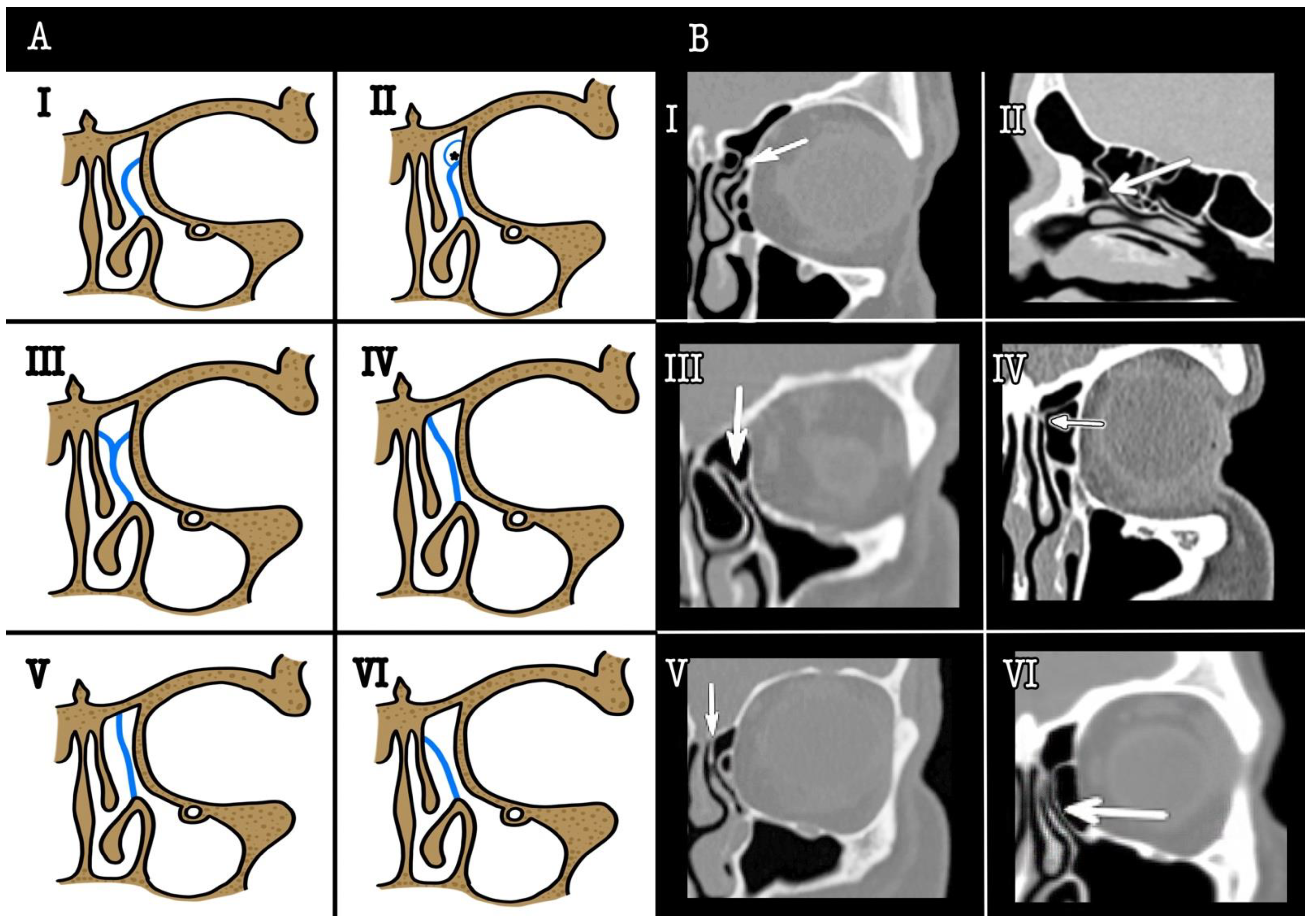 Surgeries | Free Full-Text | Relationship between the Superior Attachment  of the Uncinate Process and Pneumatization of the Middle Turbinate&mdash;A  Radiological Study