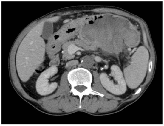 Misunderstood Gastric Perforation of a Pancreatic Acinar Cell Carcinoma: A Wolf in Sheep’s Clothing Misunderstood Gastric Perforation of a Pancreatic Acinar Cell Carcinoma: A Wolf in Sheep’s Clothing