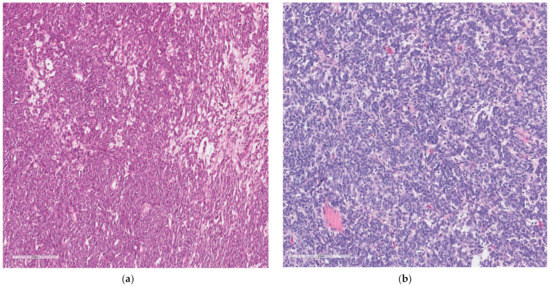 Malignant Gastrointestinal Neuroectodermal Tumor: A Case Report and ...