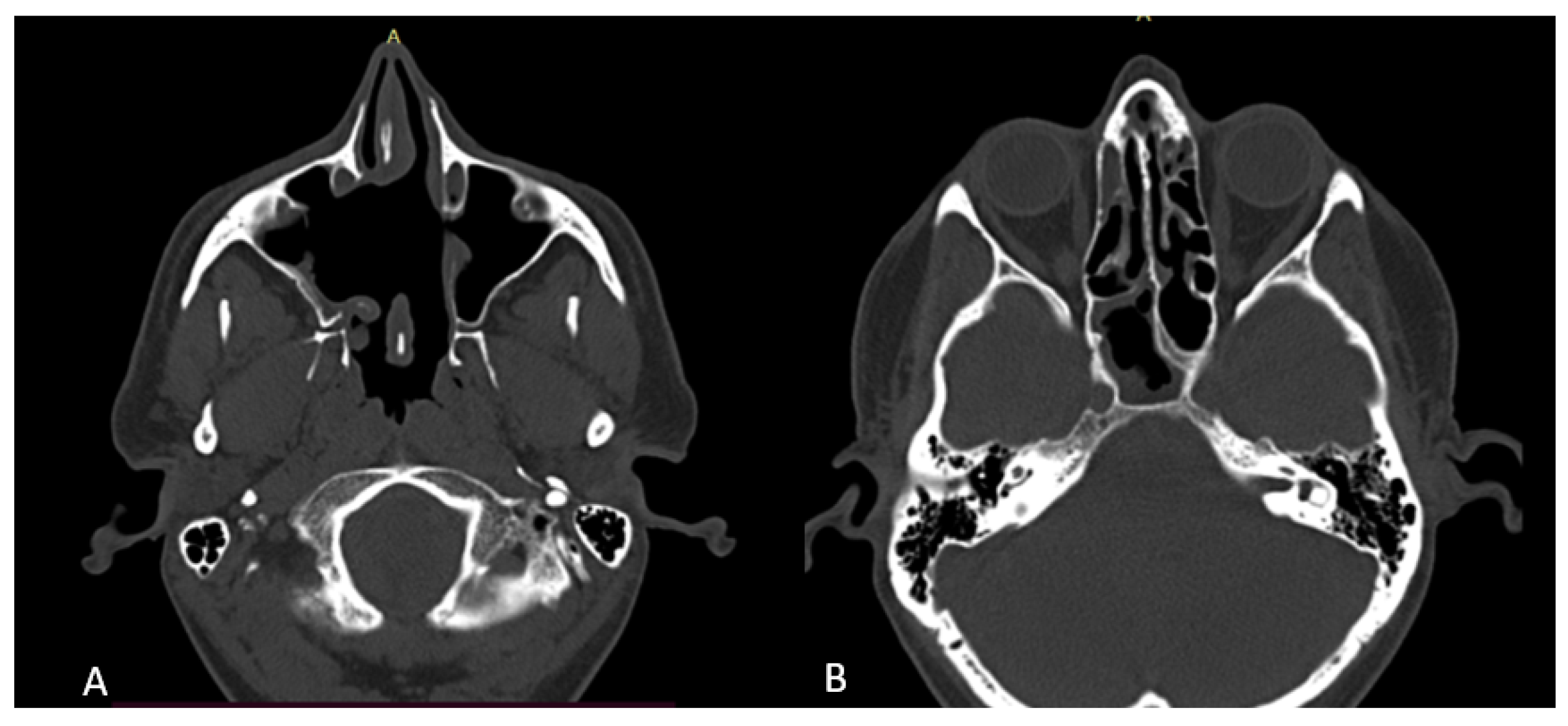 Surgeries Free FullText Endoscopic Excision of Rare Large