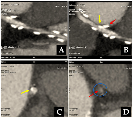 Radial Artery Used as Conduit for Coronary Artery Bypass Grafting