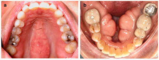 The Prevalence of Maxillary and Mandibular Exostosis in the Mississippi ...