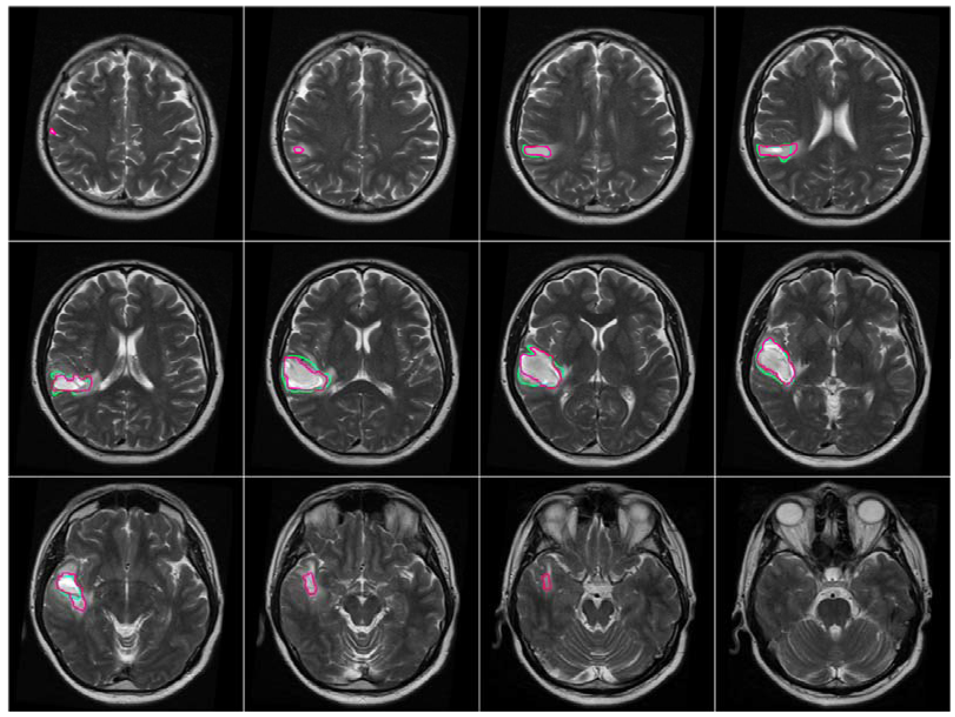Symmetry Free Full Text Segmentation Of Brain Tumors In Mri Images